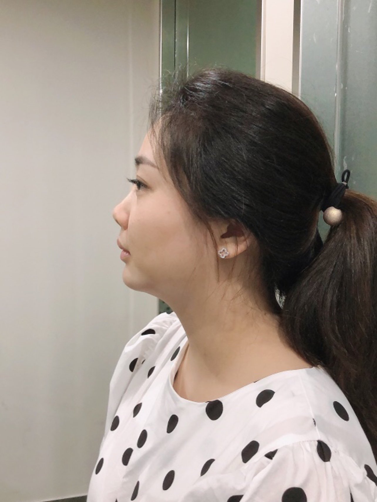 从侧面看,面部中下部位因下巴后缩短小,显的整体缺少立体感.