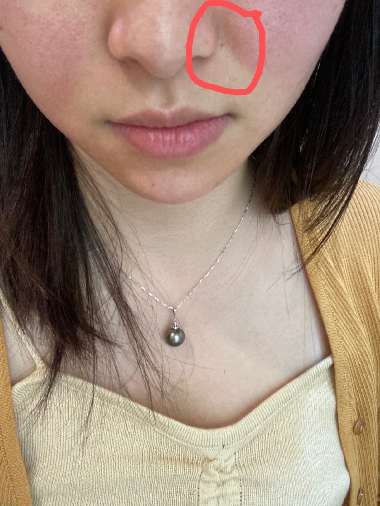 玻尿酸填充鼻基底,李涛医生技术太好了,满意