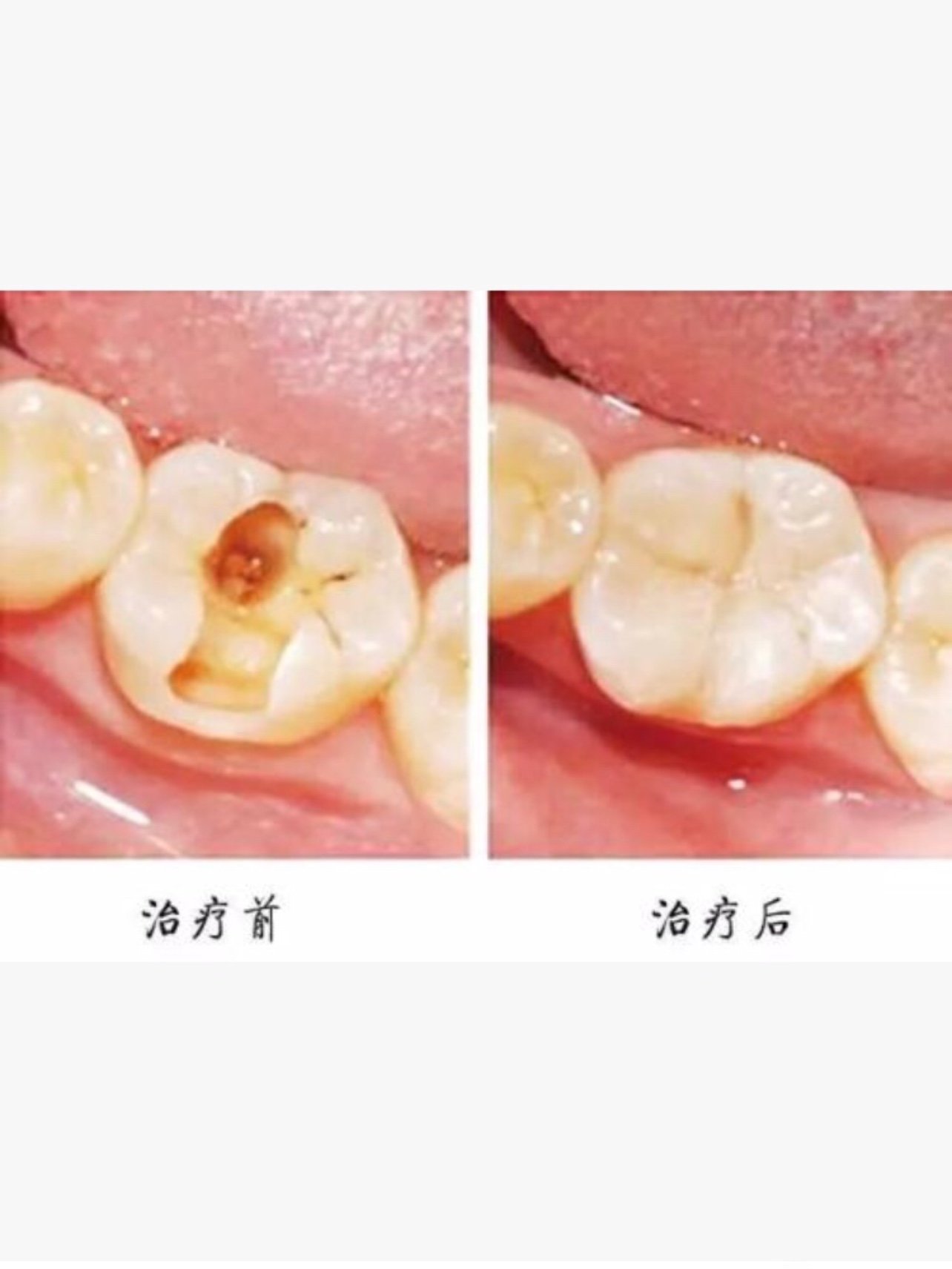 根管治疗 =杀神经?别再被人忽悠了