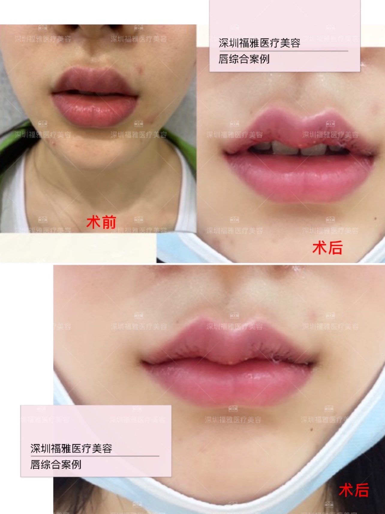 m唇手术过程图片
