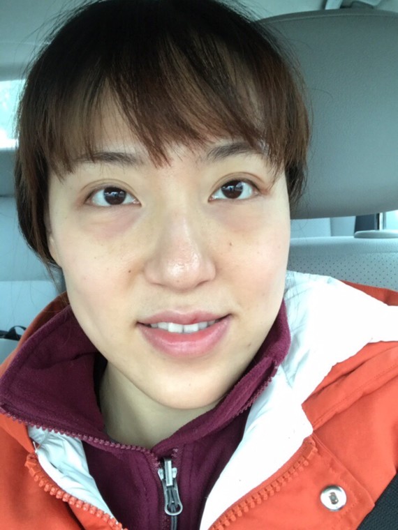 内切祛眼袋第三天