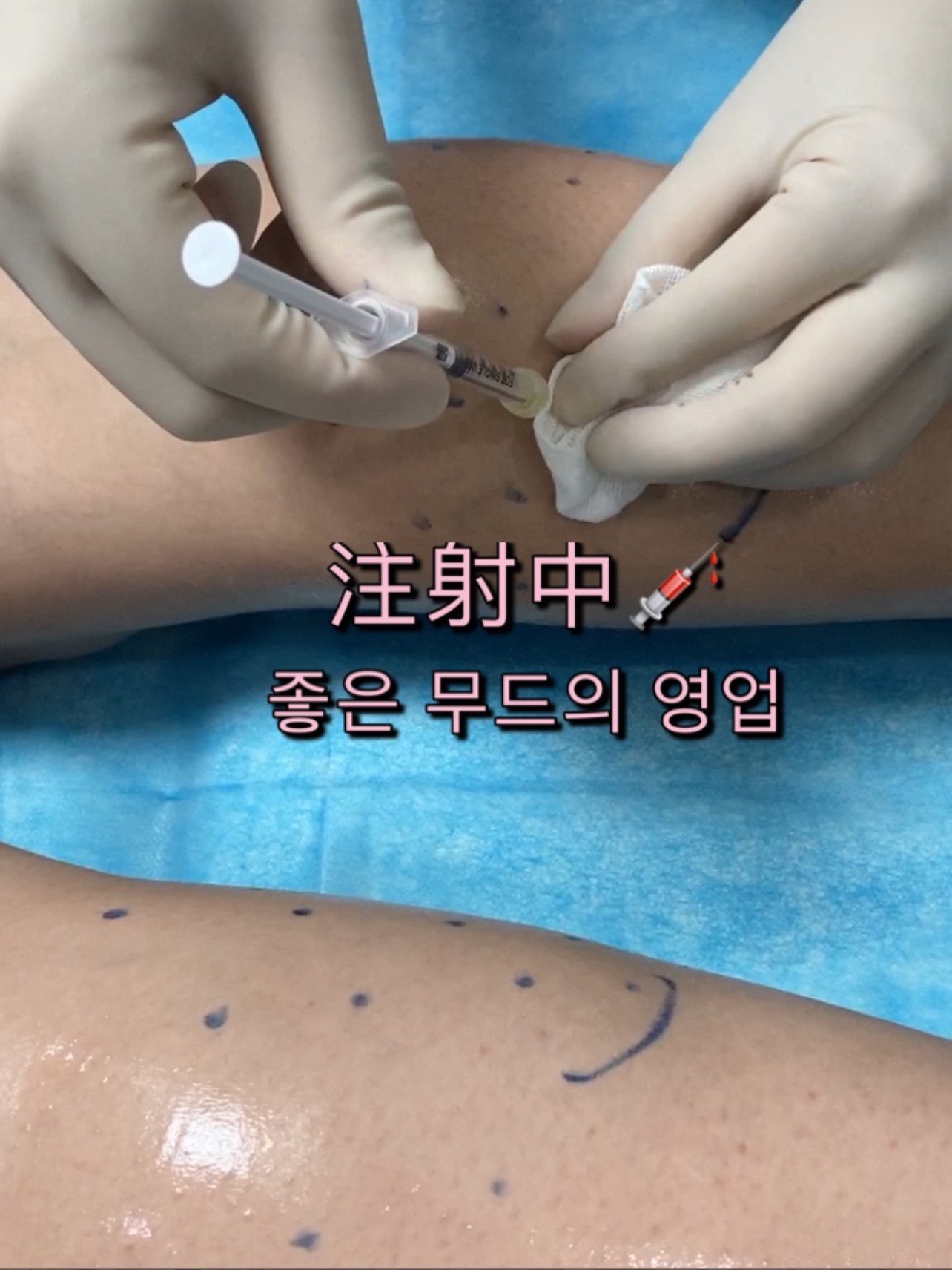 很荣幸被选中成为瘦腿针的体验官,已经注射一周啦,恢复得很好打针的