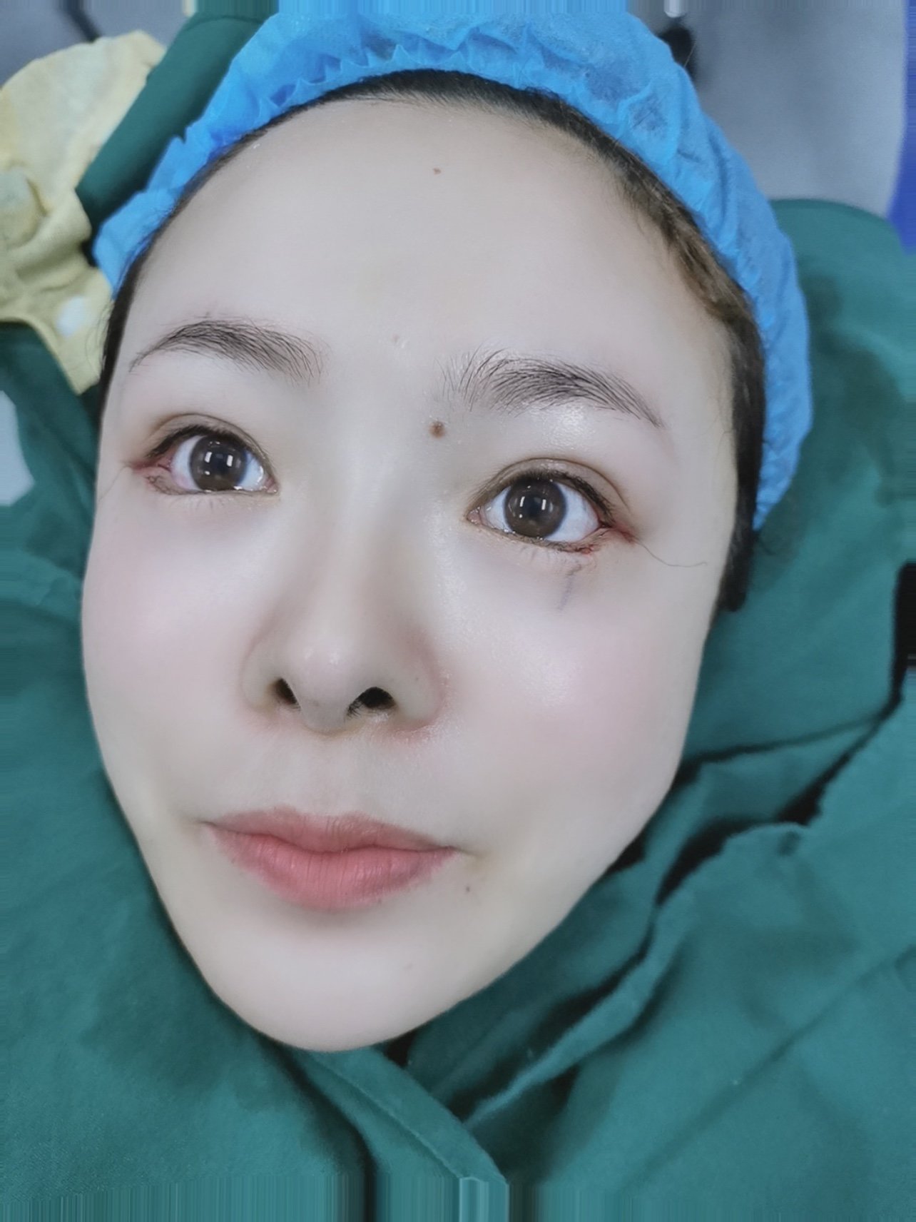 下眼下至77术后即刻