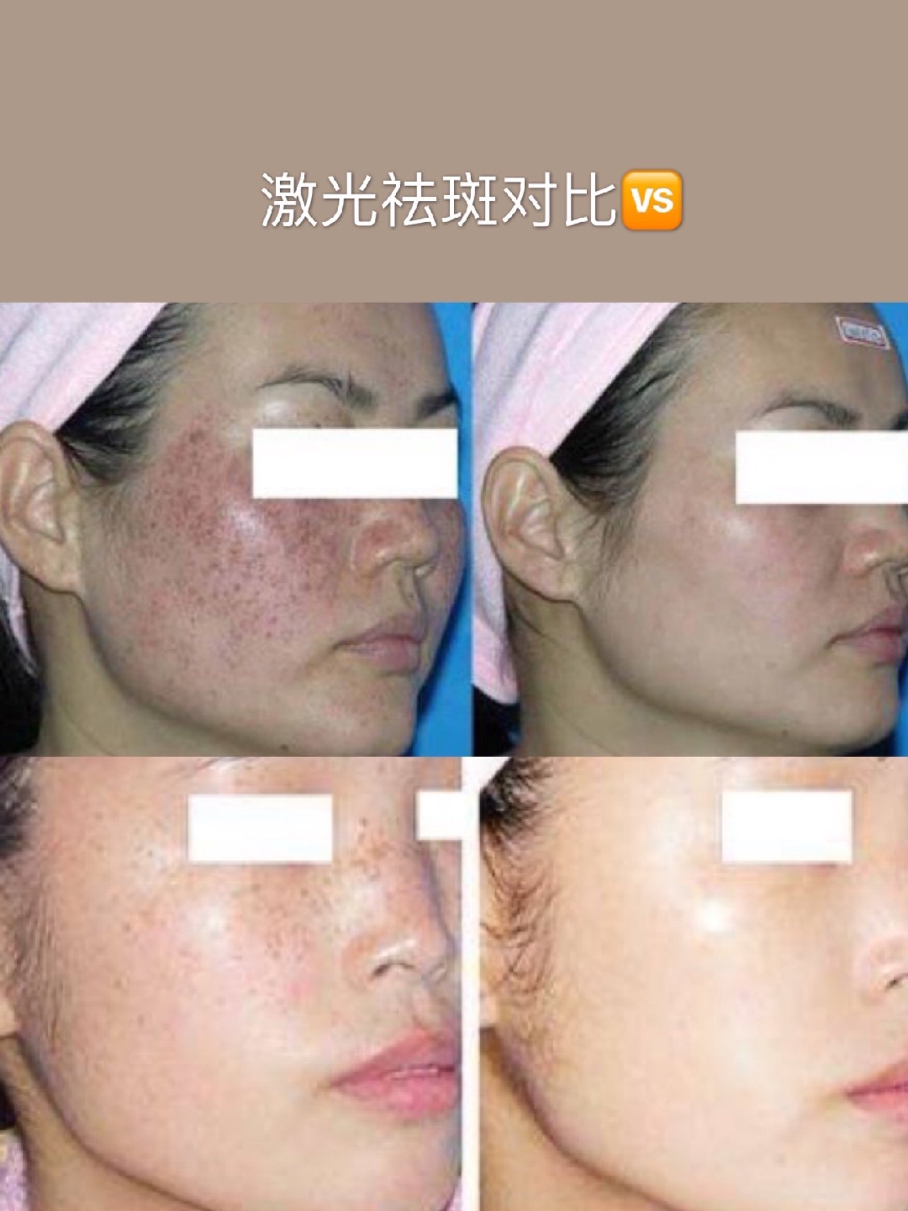 皮秒祛斑做完皮肤会变薄吗