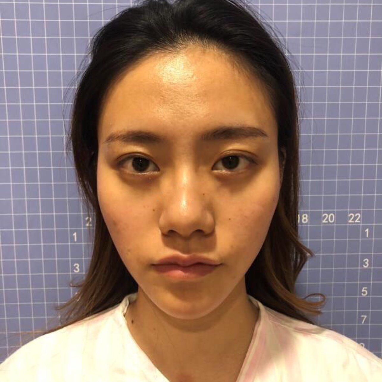 从图二可以看出我的脸凹陷比较严重气色也很不好,看起_圈子-新氧美容