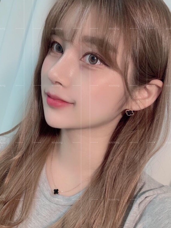 鼻修复—驼峰鼻矫正