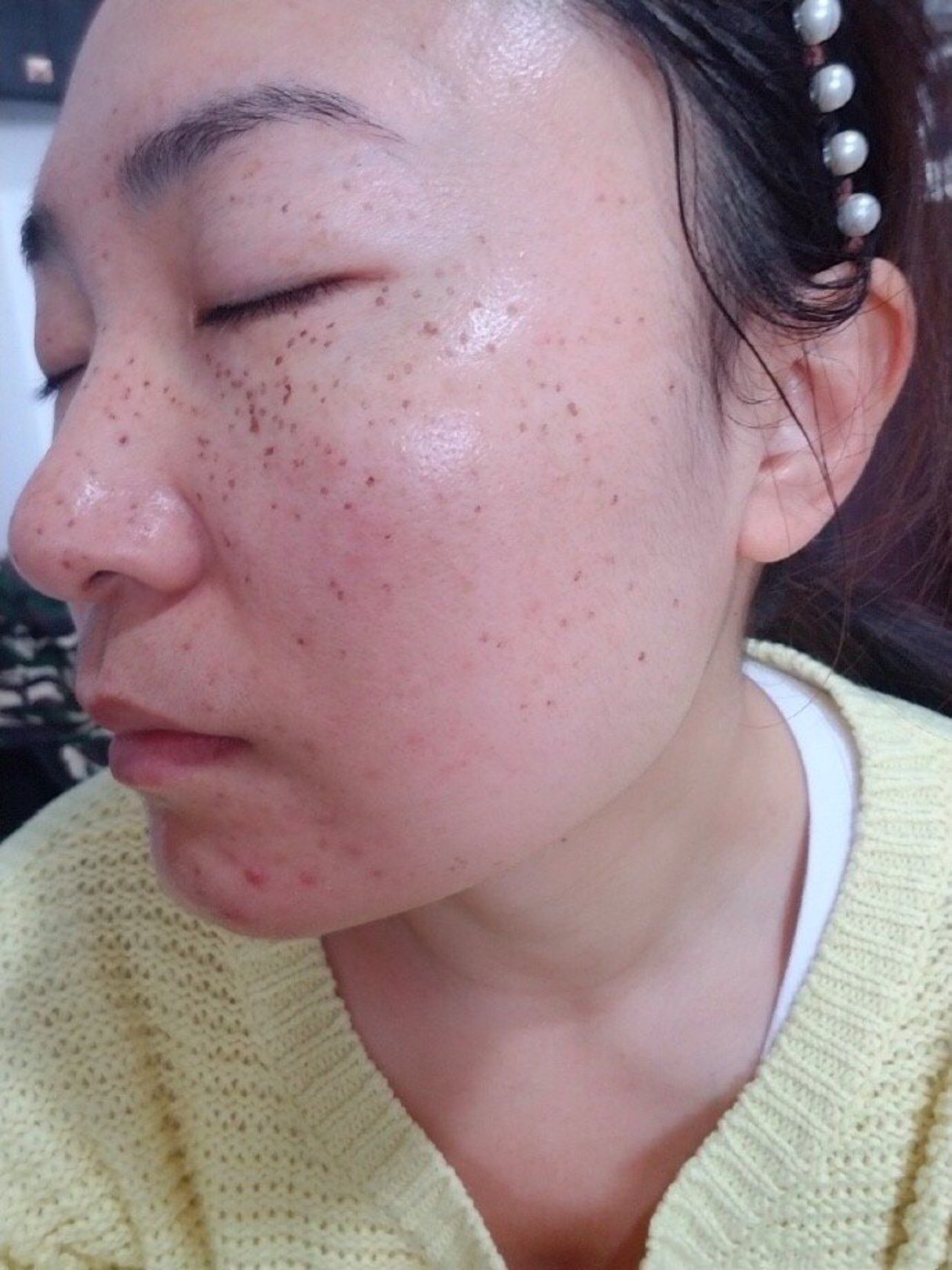 不做好防晒的话会反黑,色素沉淀会变的比之前还要严重,遗传性雀斑遗传