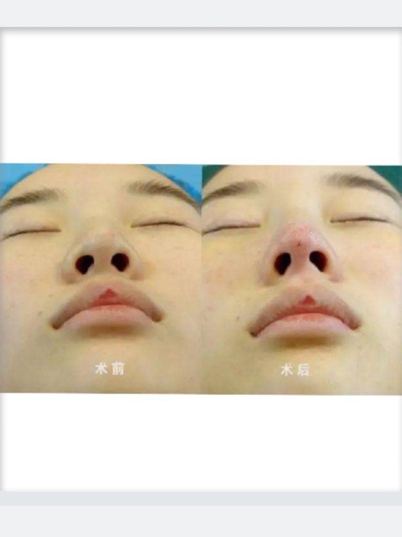 线雕鼻到底能不能做?蛋白线真的会被吸收吗?