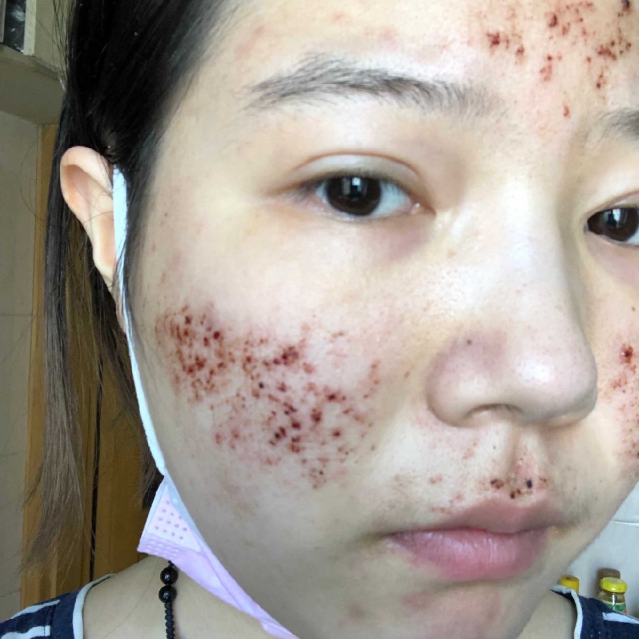 看到脸上有的痂要掉不不掉的,特别想抠,是真的要努力_圈子-新氧美容