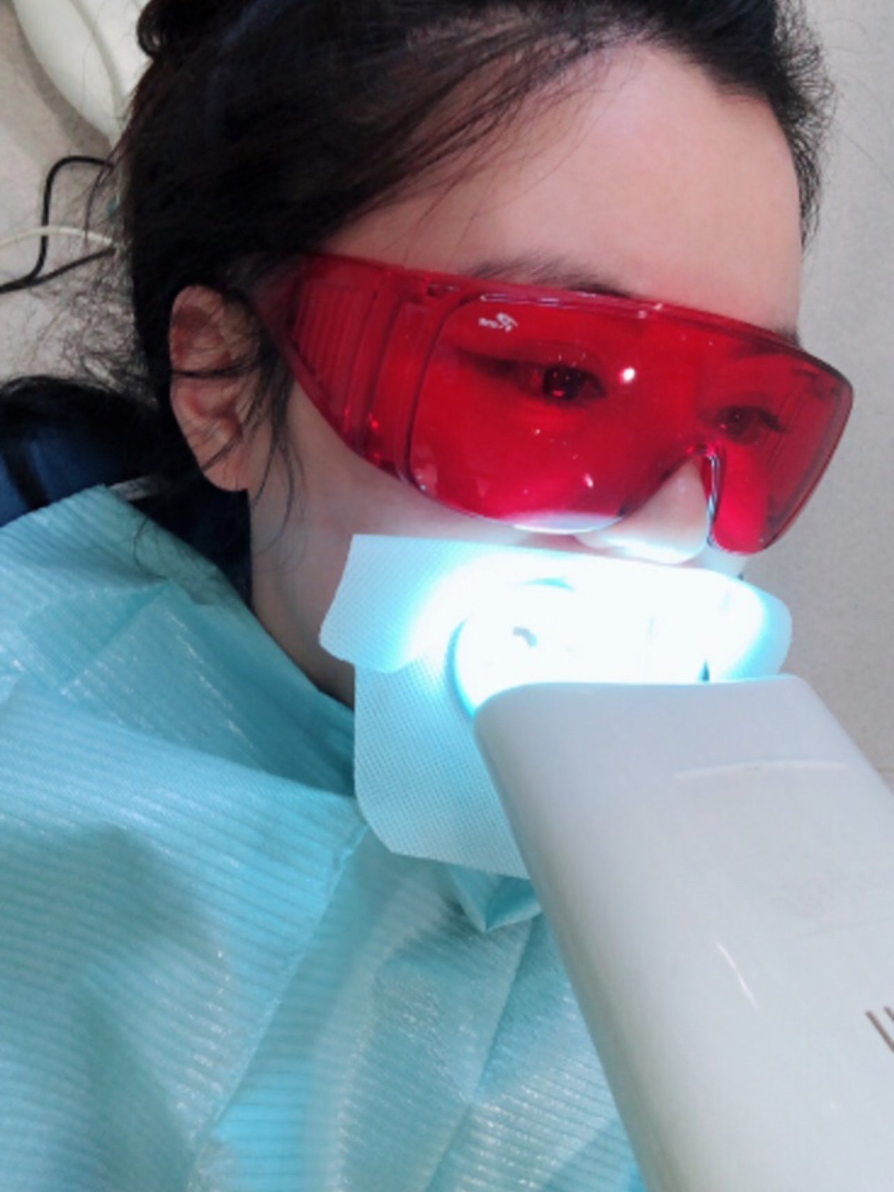 让牙齿发光——冷光美白牙齿分享