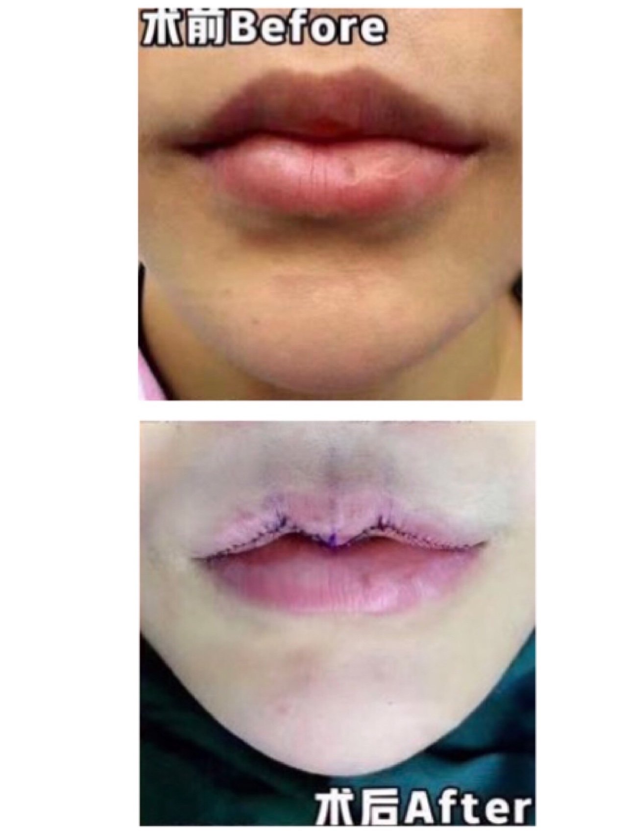 今天又是一位来改造唇形的小姑娘想要改造成微笑唇