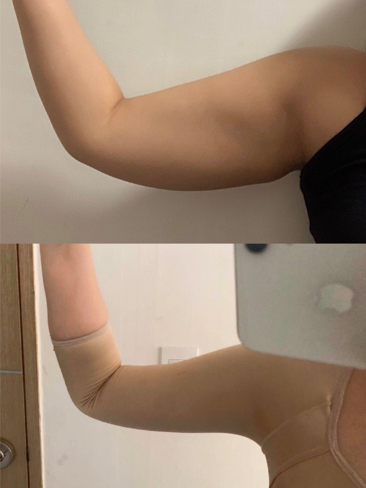 手臂吸脂腋下吸脂副乳吸脂