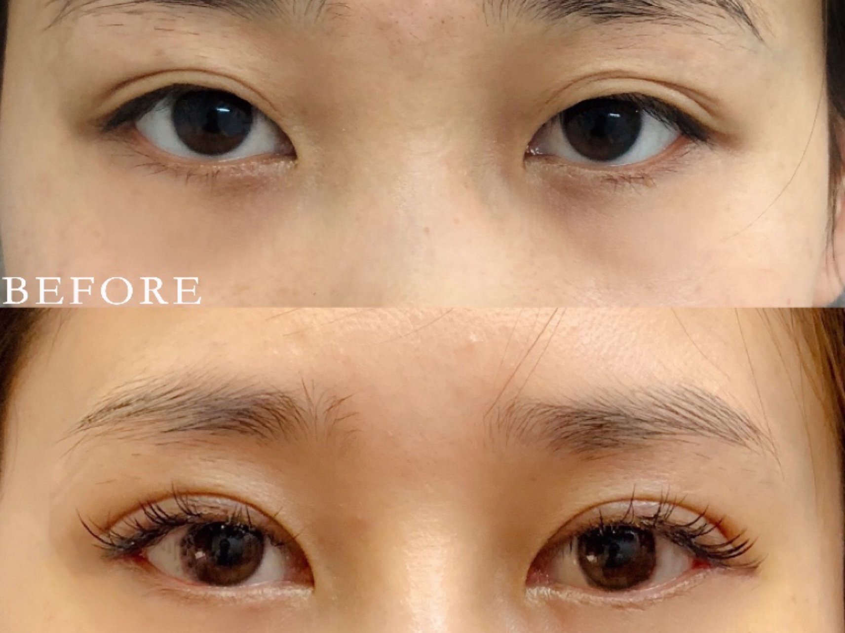 多层双眼皮案例分享