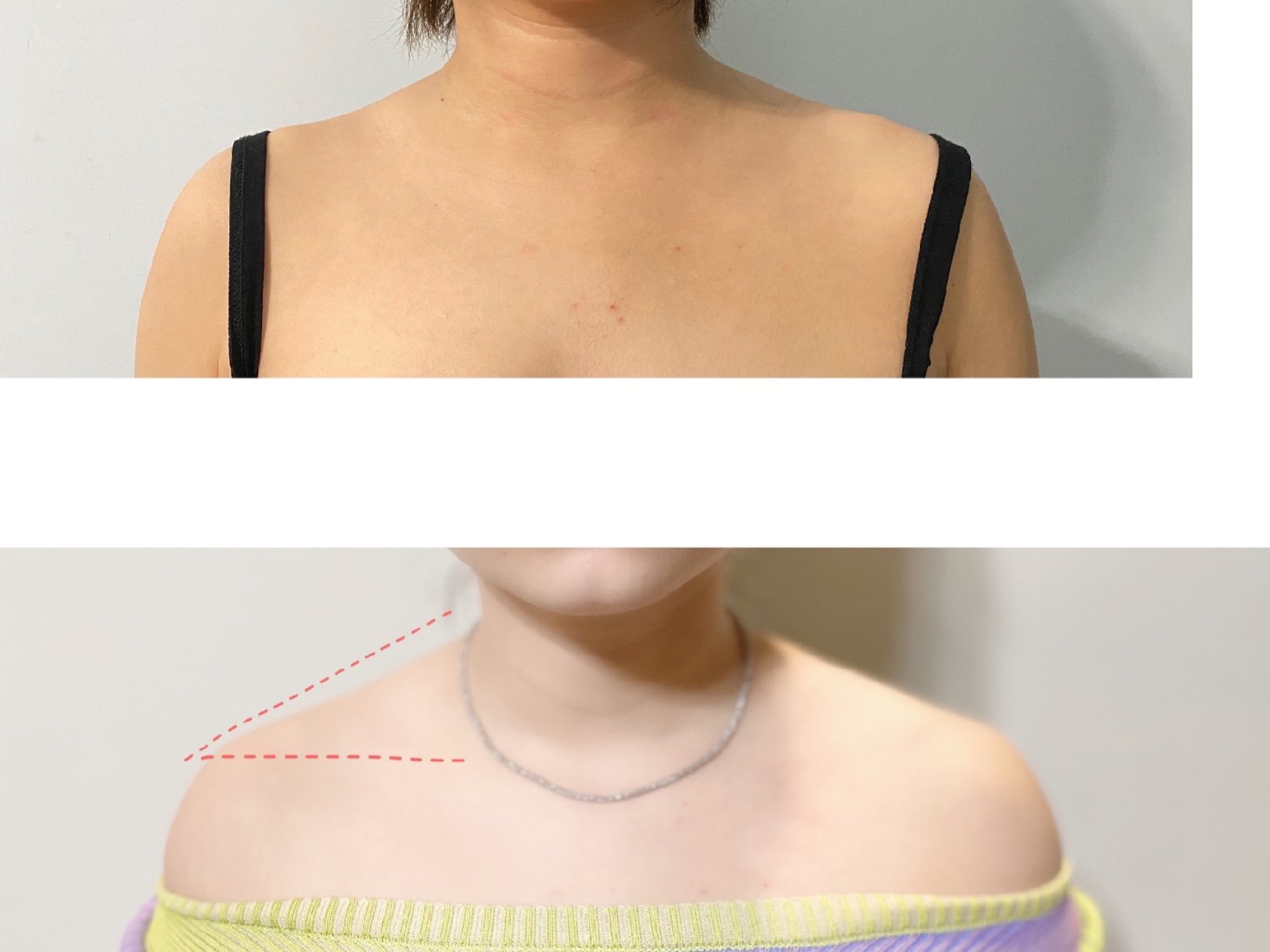 【瘦肩针】真人实录