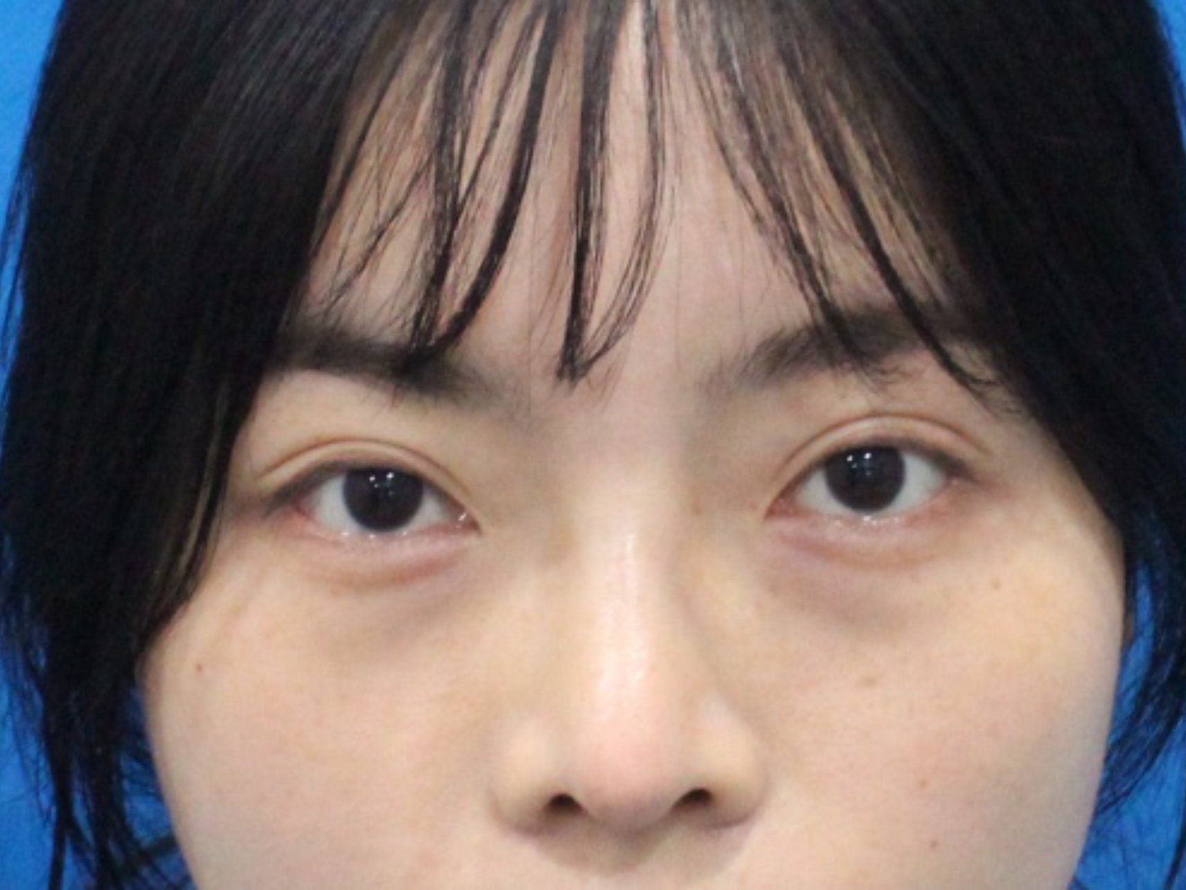 现在眼睛恢复的蛮好的,眼袋在眼睛上挂了有两三年了,_圈子-新氧美容