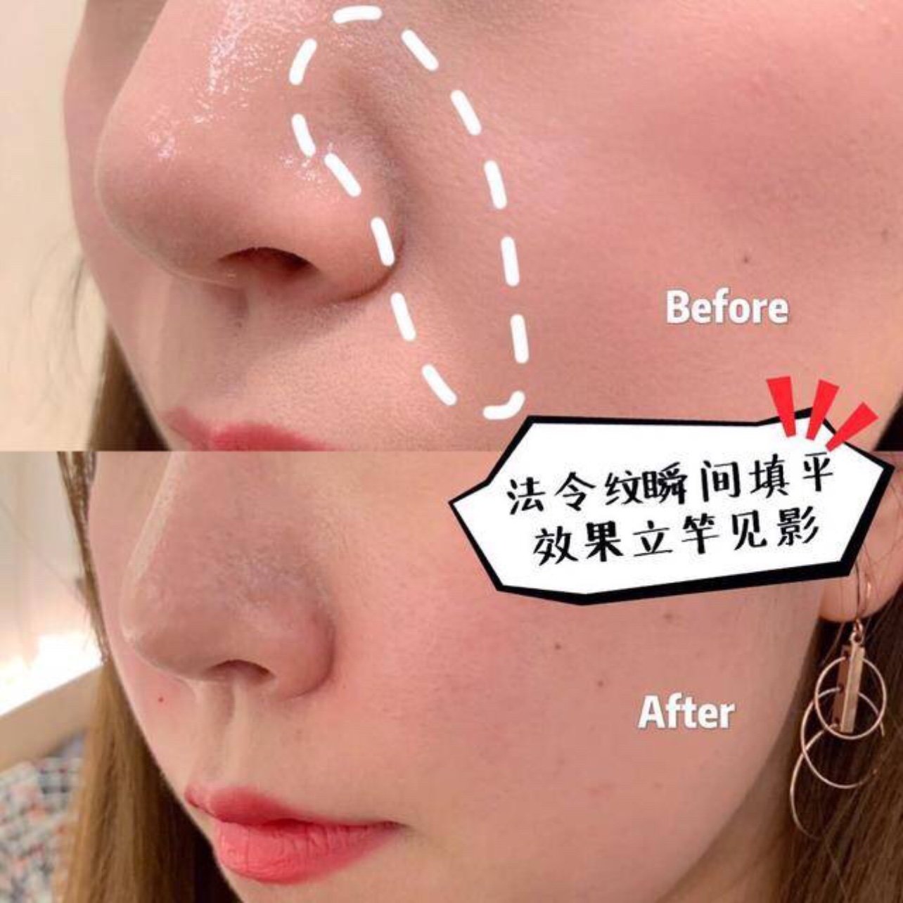 消除法令纹心得:埋线or填充 哪种方式最管用