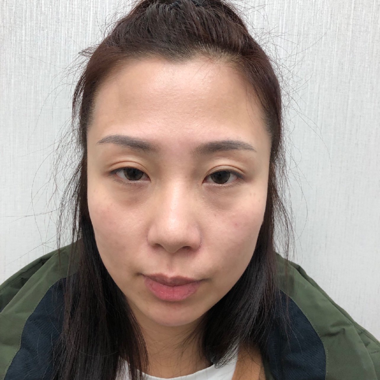 眼睛不好看,想做的好看一点,眼皮比较塌,我之前没做过双眼皮,但是眼睛