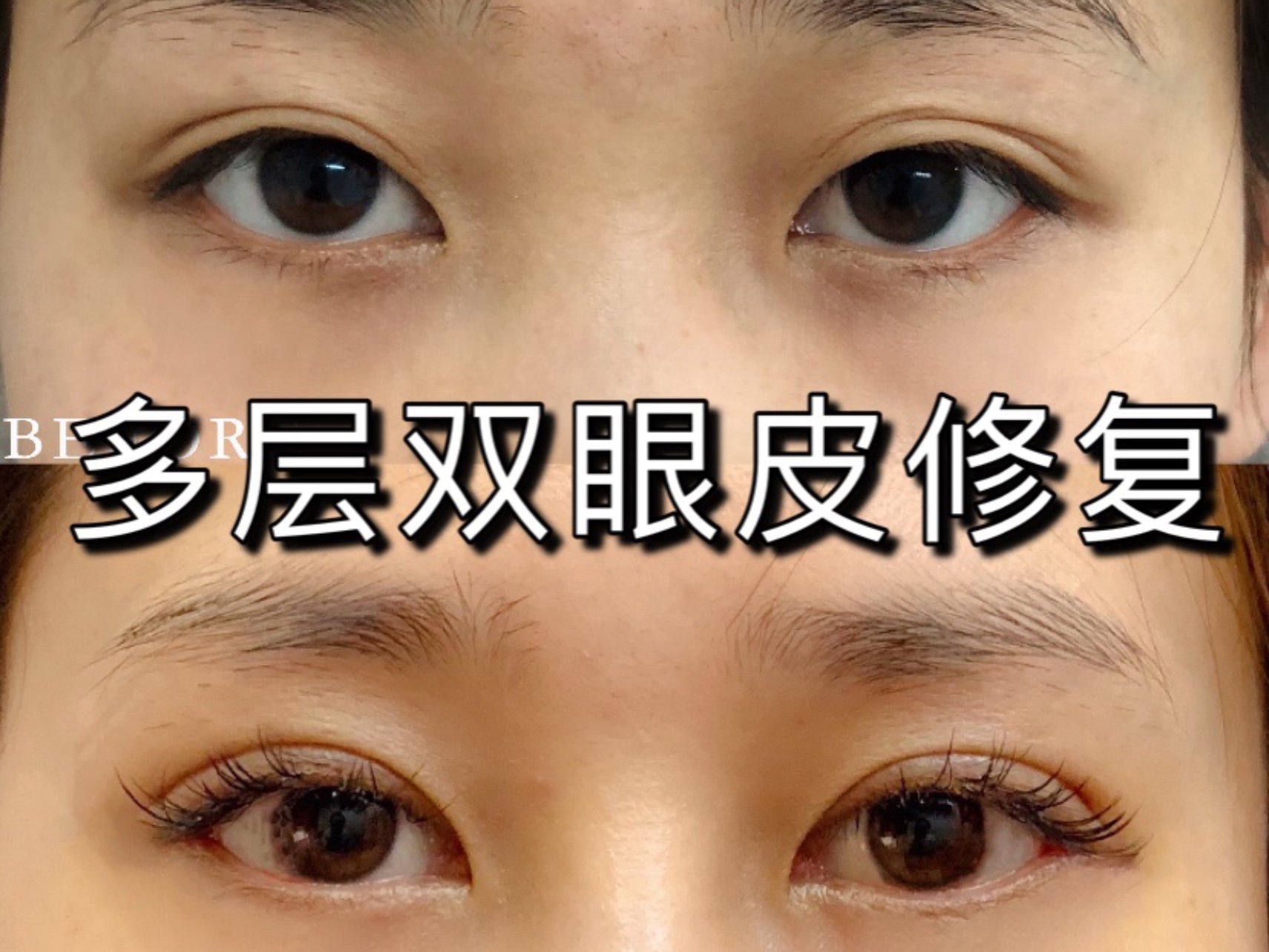 多层双眼皮案例分享