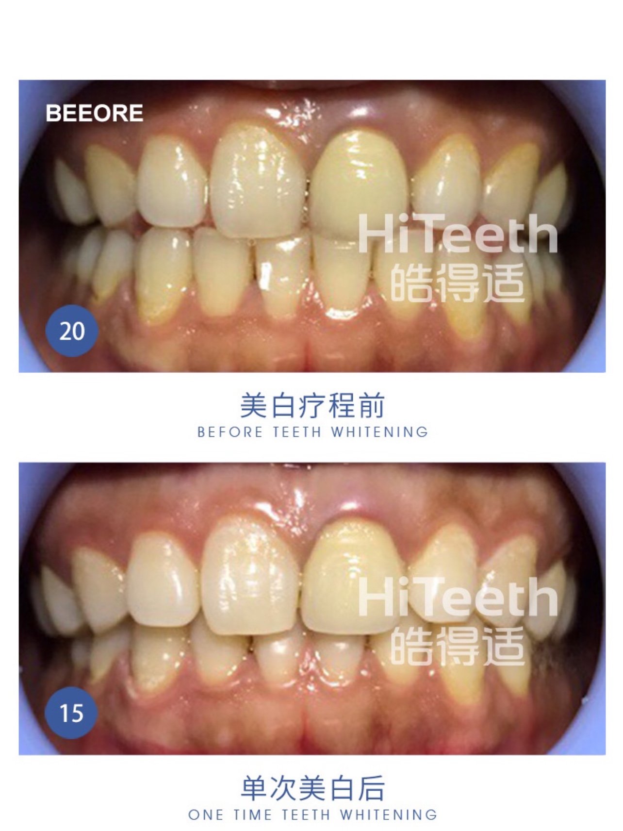 做了烤瓷牙能不能再做美白?