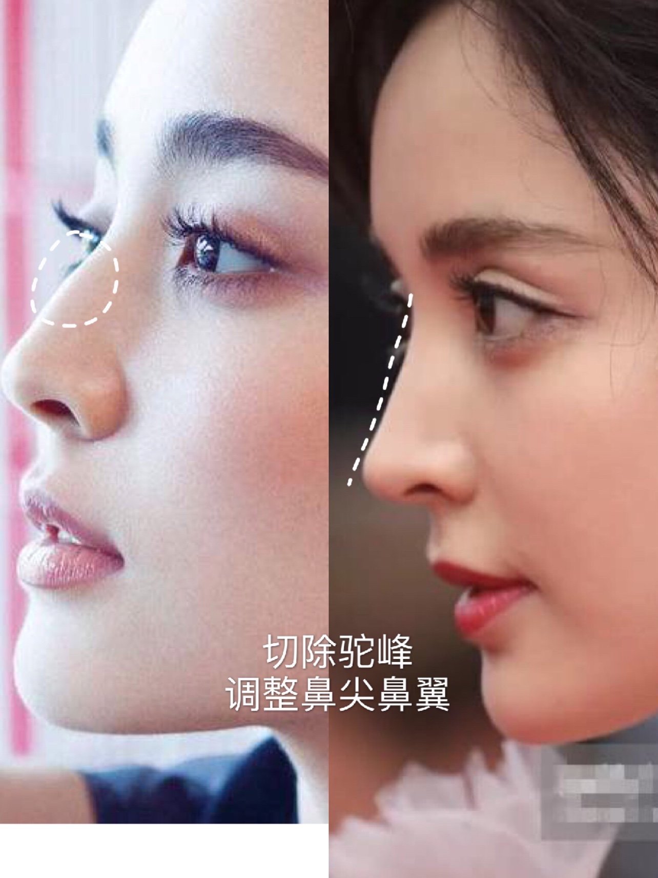 赵露思的鼻子是怎么成为整形模版晒出你的侧颜杀