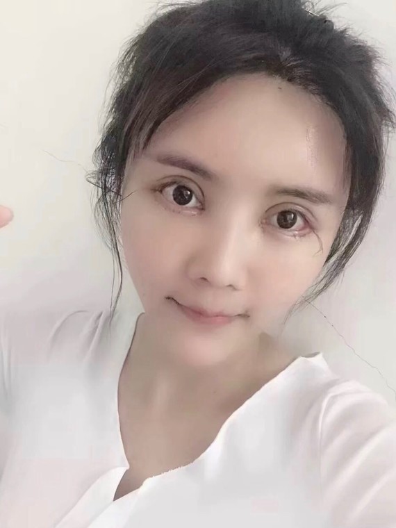 平行双眼皮修复开扇形