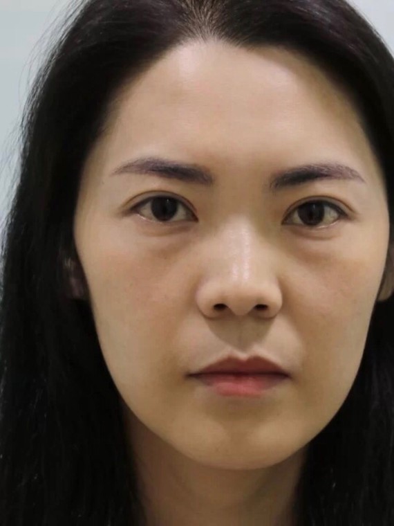 有眼袋,医生教你一招"消灭不见"