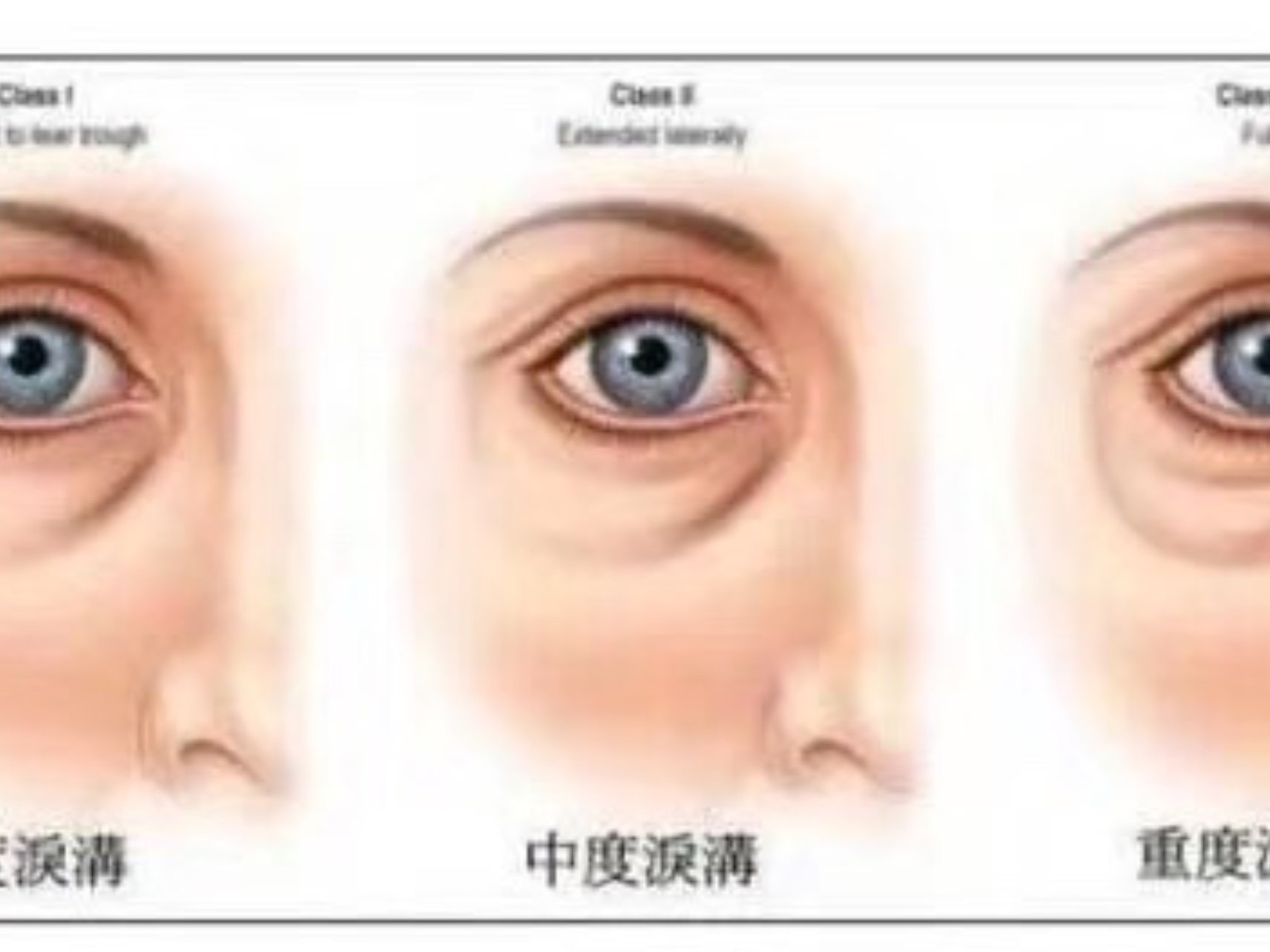 前期介绍了有关眼袋和卧蚕的区别,今天给大家区分一下眼袋和泪沟.