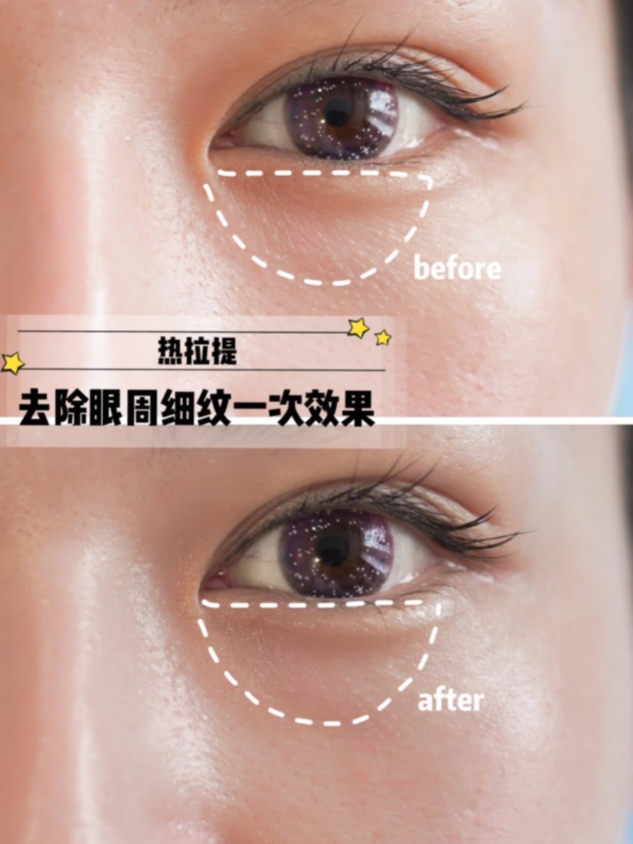 纠结了很久做眼周热玛吉还是热拉提 对比下 两者都是通过脉冲技术唤醒