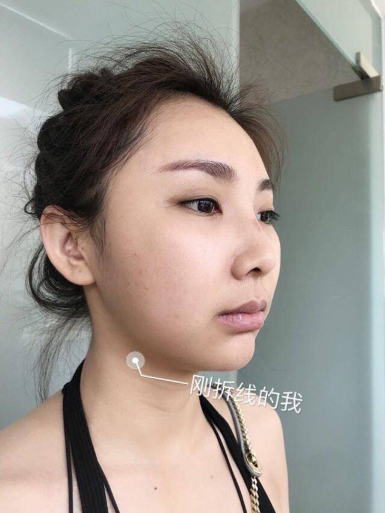 73颧骨磨骨下颌角截骨没有下垂的迹象哦