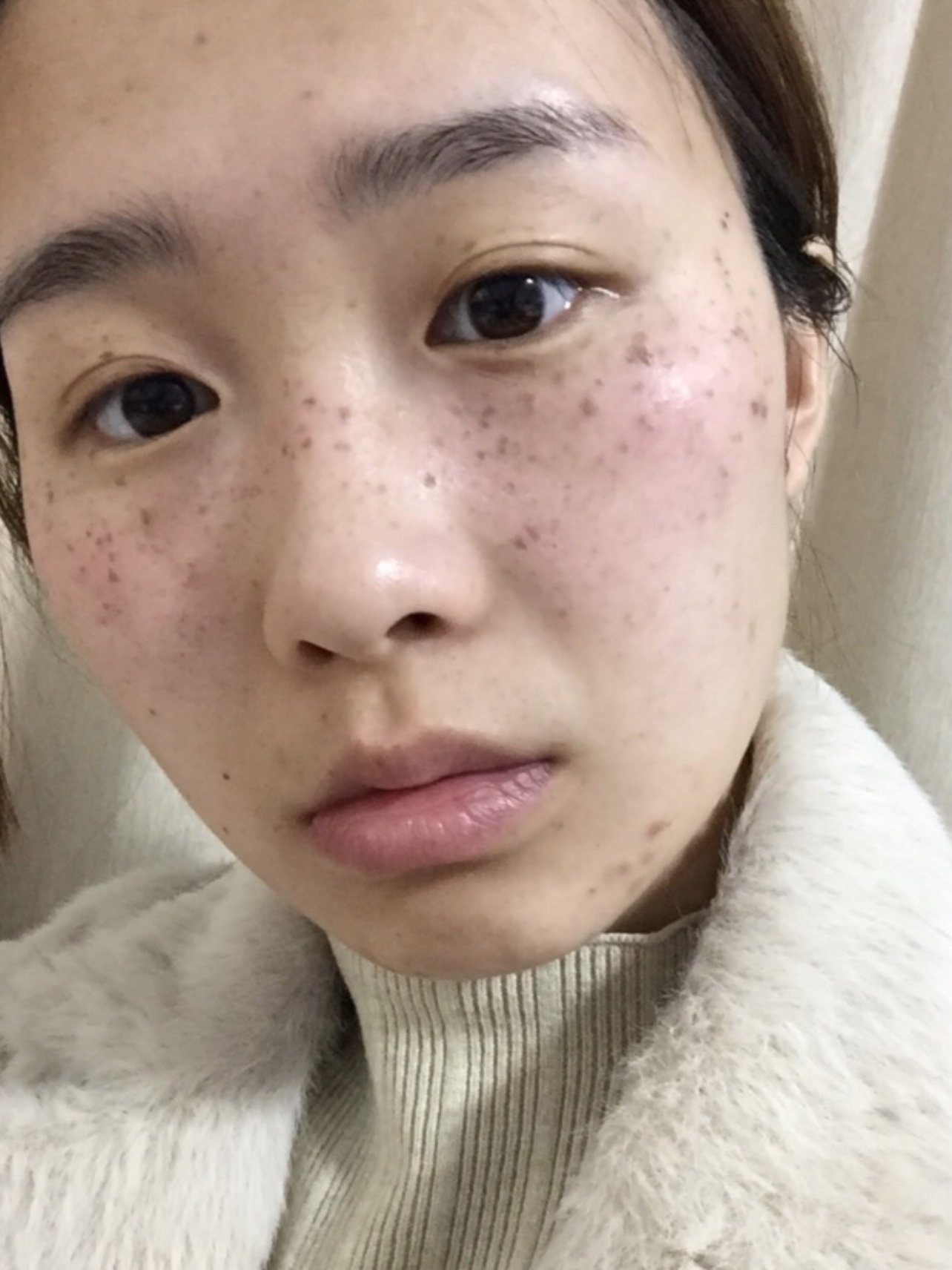 首页 此页面仅支持预览 Avatar 严爱丽美容整形 140篇日记 第一次激光祛斑的效果分享 雀斑类型 遗传性雀斑 手术设备 M22王者之心 价格 三个疗程4500软妹币 修复产品 医用修复面膜 伊思白蜗牛面霜 防晒 硬防晒 帽子 口罩 防晒伞 做