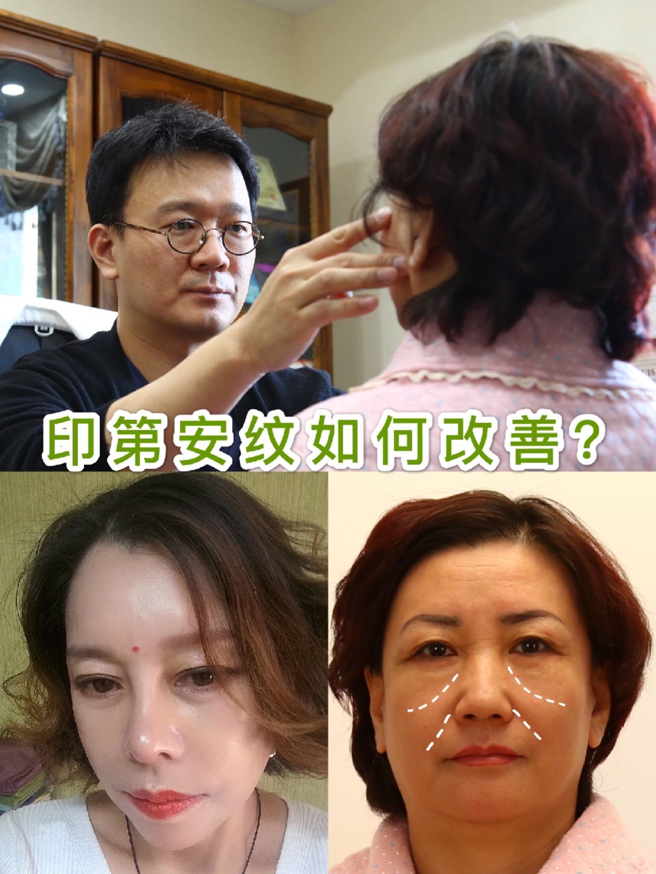 95印第安纹是指颧骨凹陷的部分,_圈子-新氧美容整形