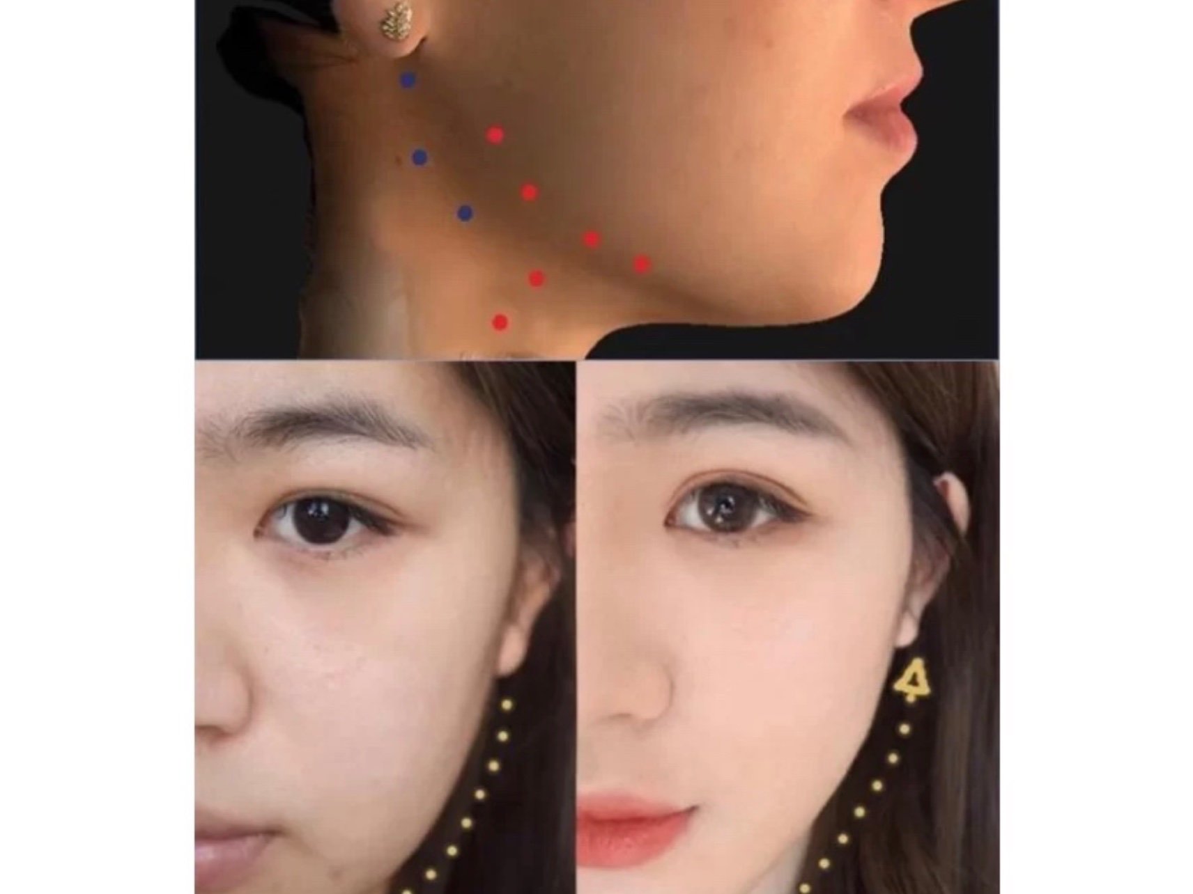 科普:打瘦脸针,建议再联合下颌缘提升