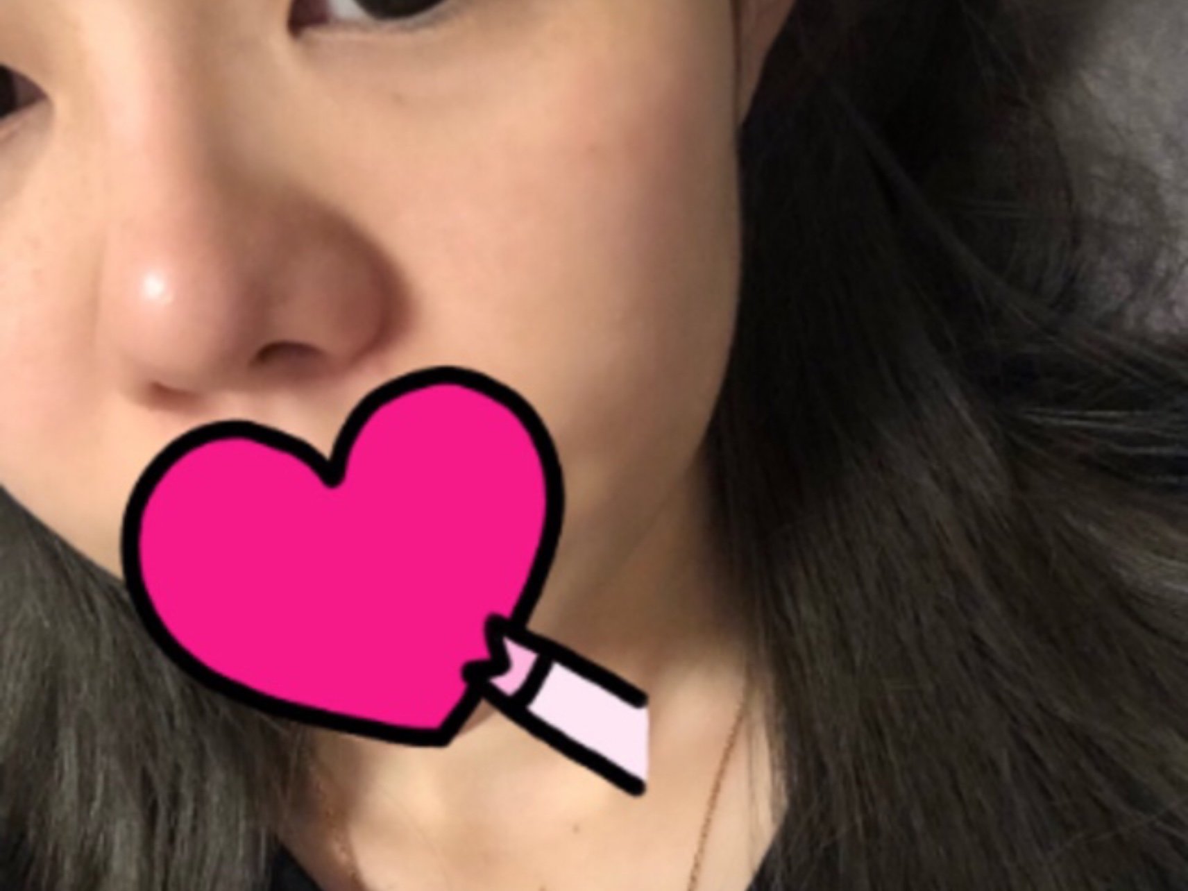 原理是利用负压多针将玻尿酸打进皮肤的真皮层 我打的是菲洛嘉贝洛 