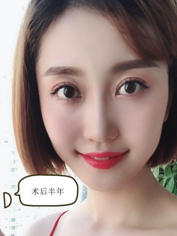 上睑提肌,给你一双有神的双眼有些人割了双眼皮,但是_圈子-新氧美容