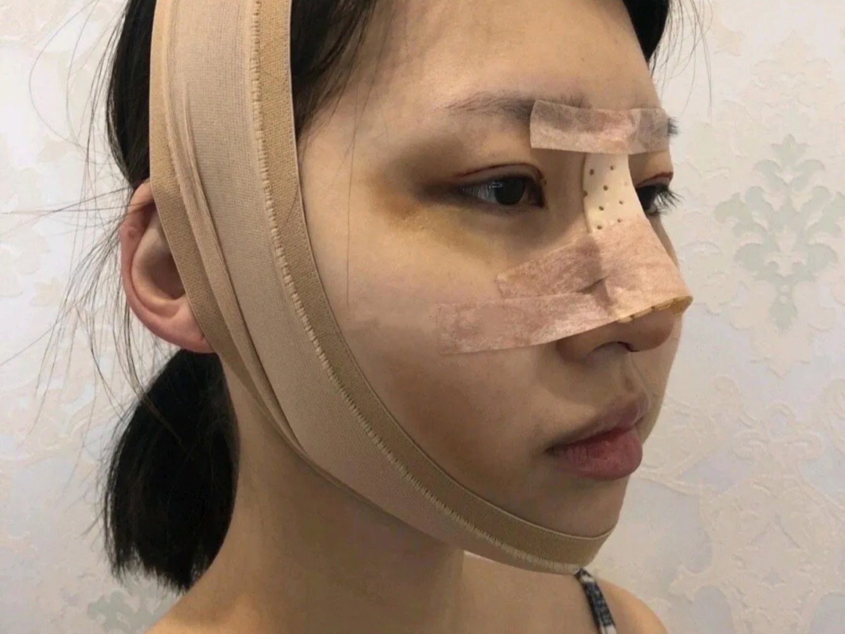 太好了 做了一次单纯垫鼻梁太后悔了.