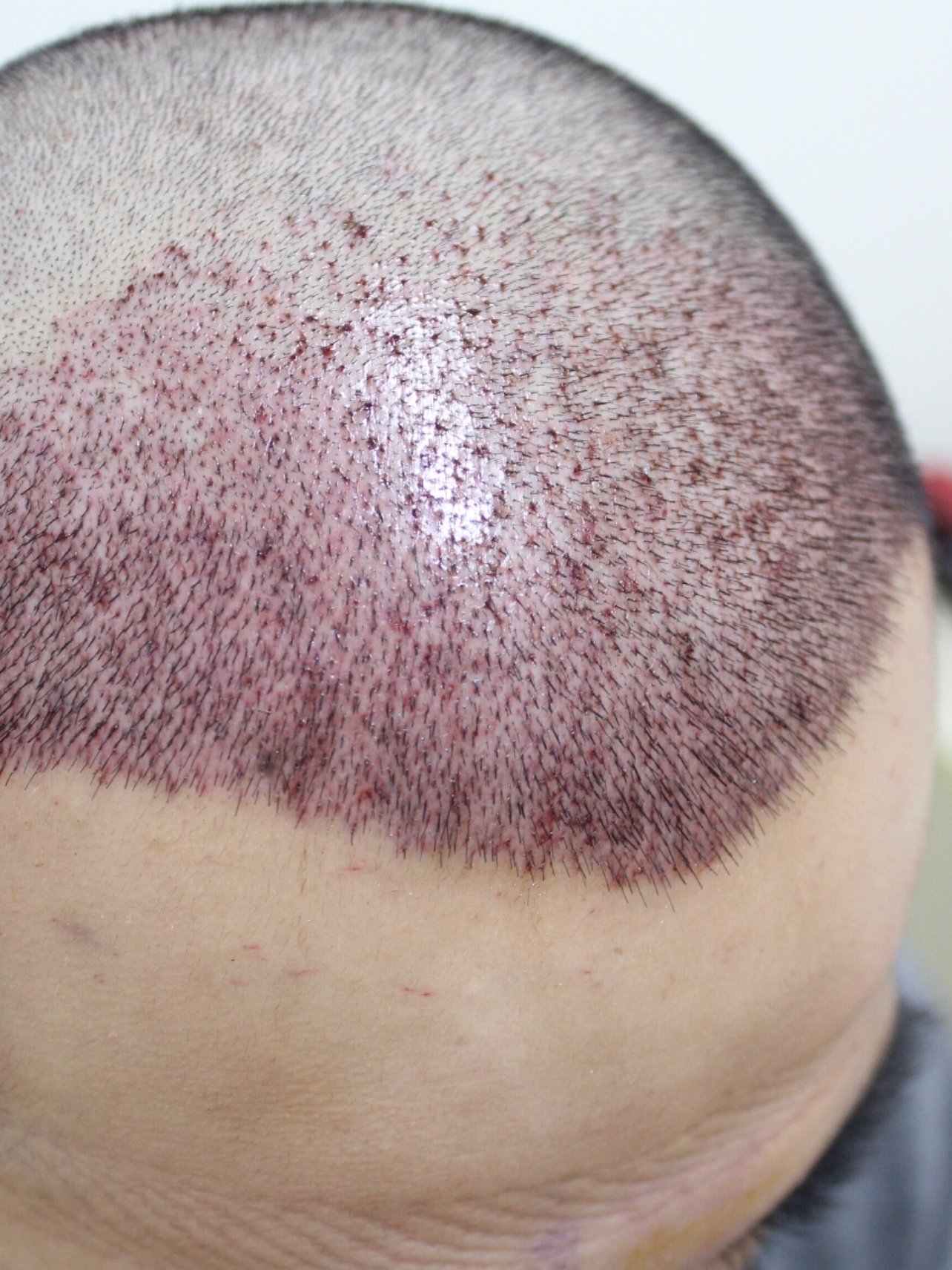 76大麦微针植发