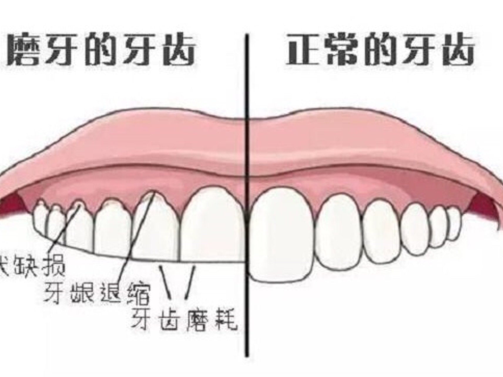 979797磨牙症的治疗方法有多种,临床上主要以减轻磨牙_圈子