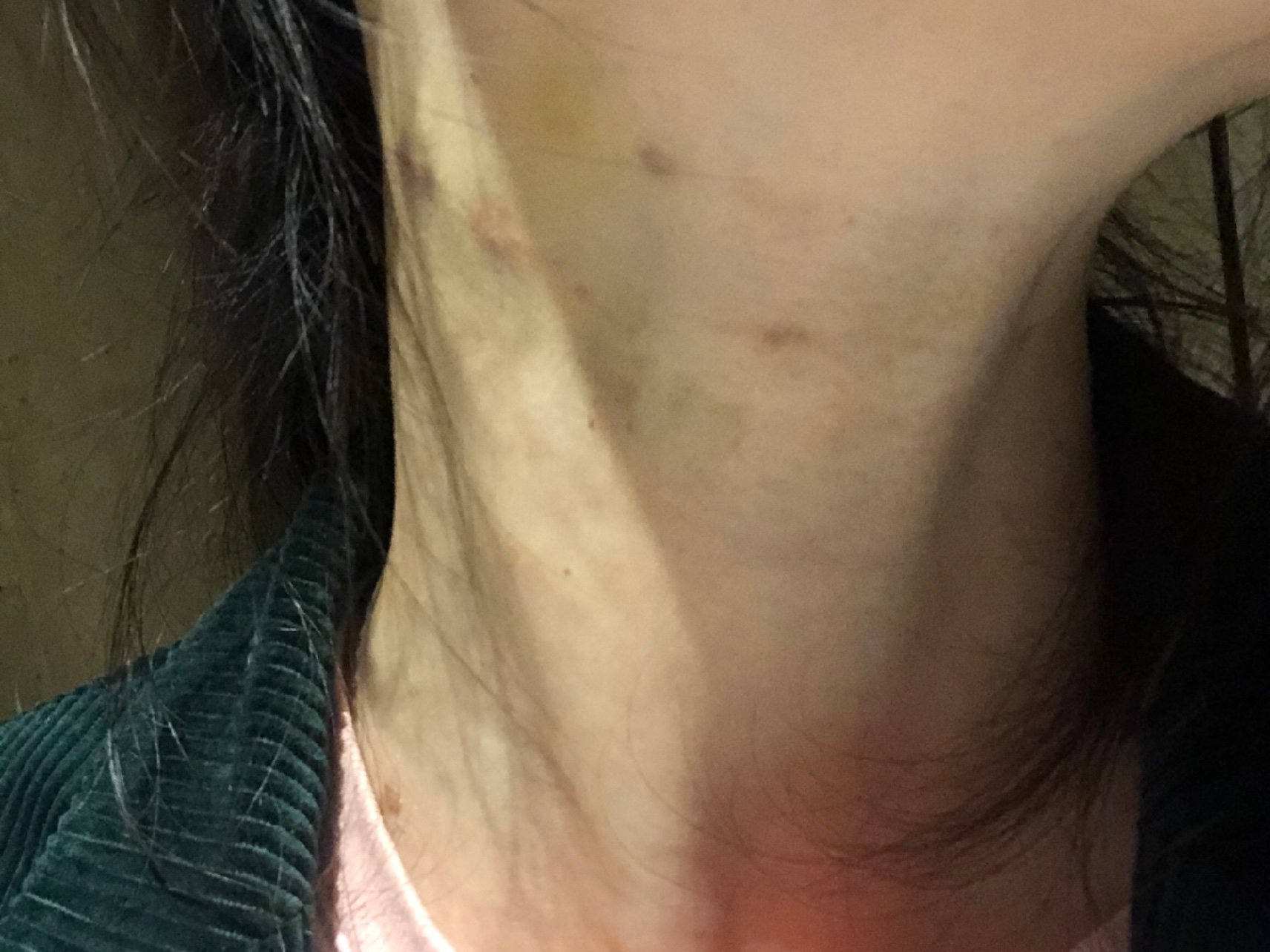 第一次打嗨体去除颈部纹路,刚打完时脖子上有不上青,_圈子-新氧美容