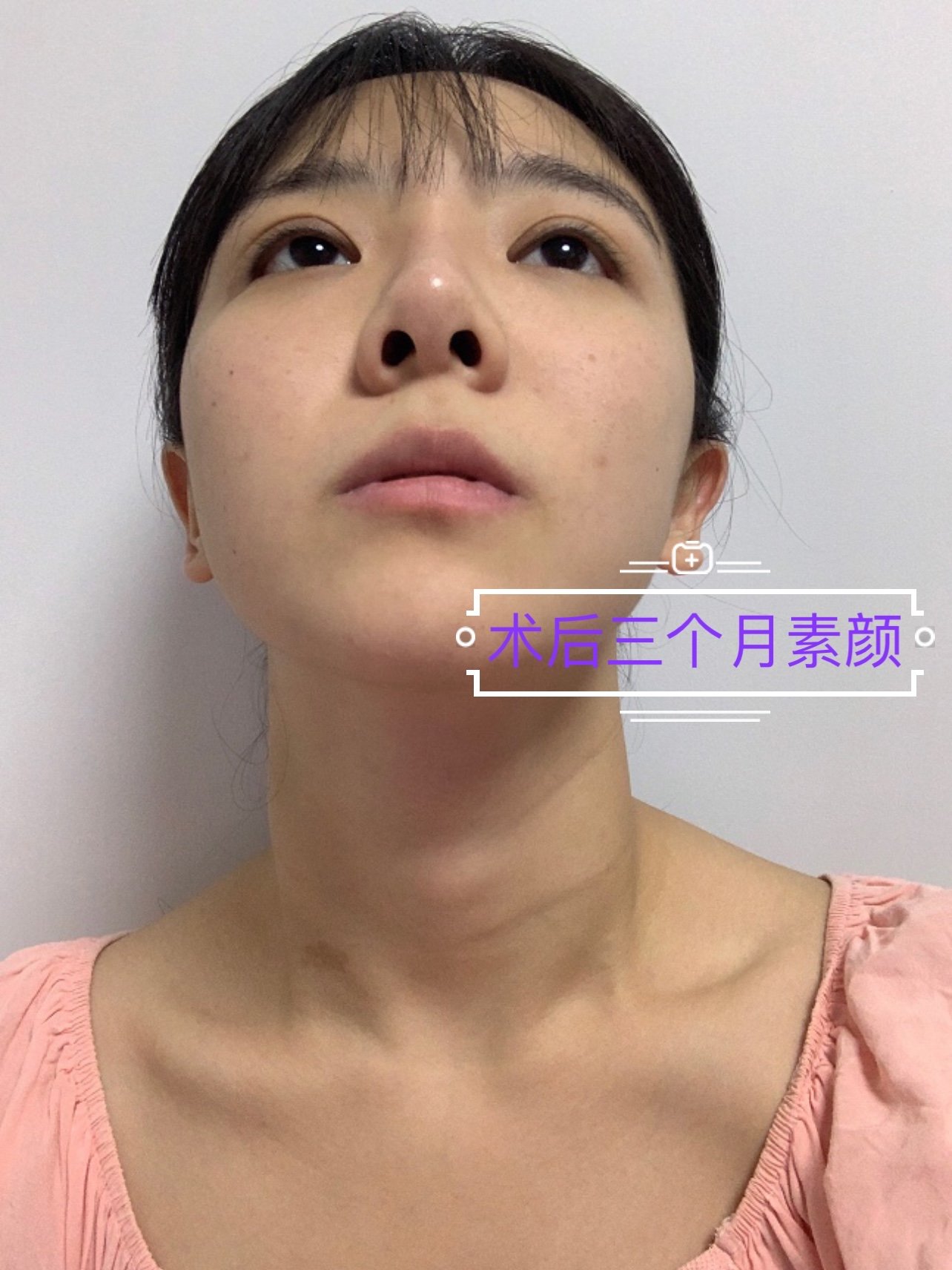 可以看到前面两张素颜的对比照,鼻孔大小的问题和鼻梁_圈子-新氧美容