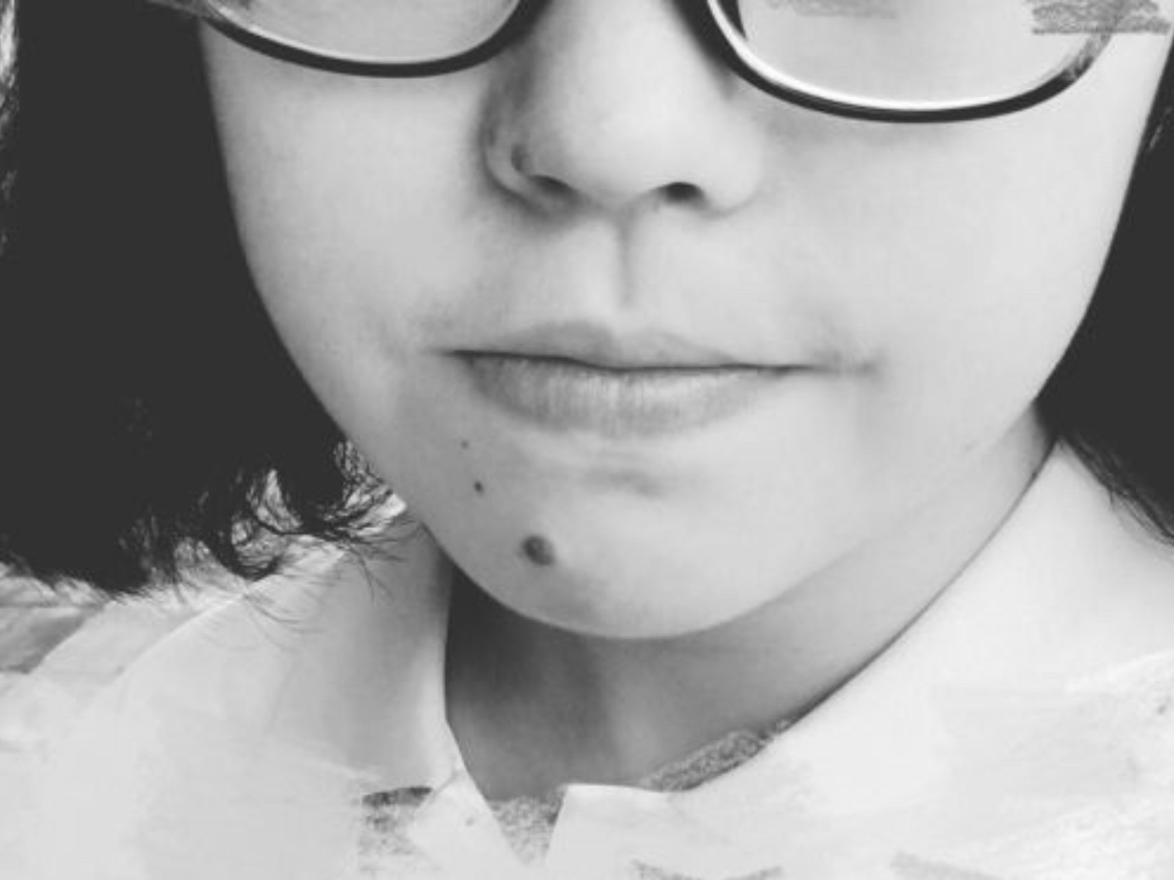 脸上其实痣有好几颗,突出的肉痣有两,直径不超过3m_圈子-新氧美容整形