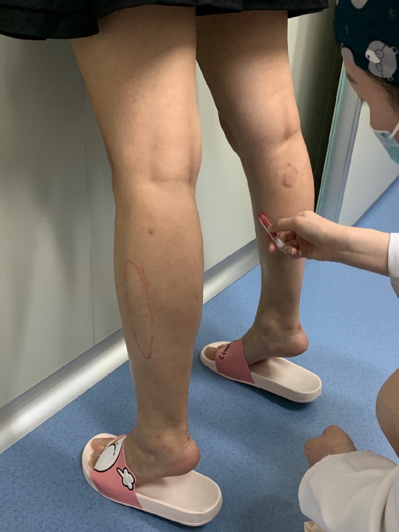 今天是注射完瘦腿针的半个月了在这说说自己的感受