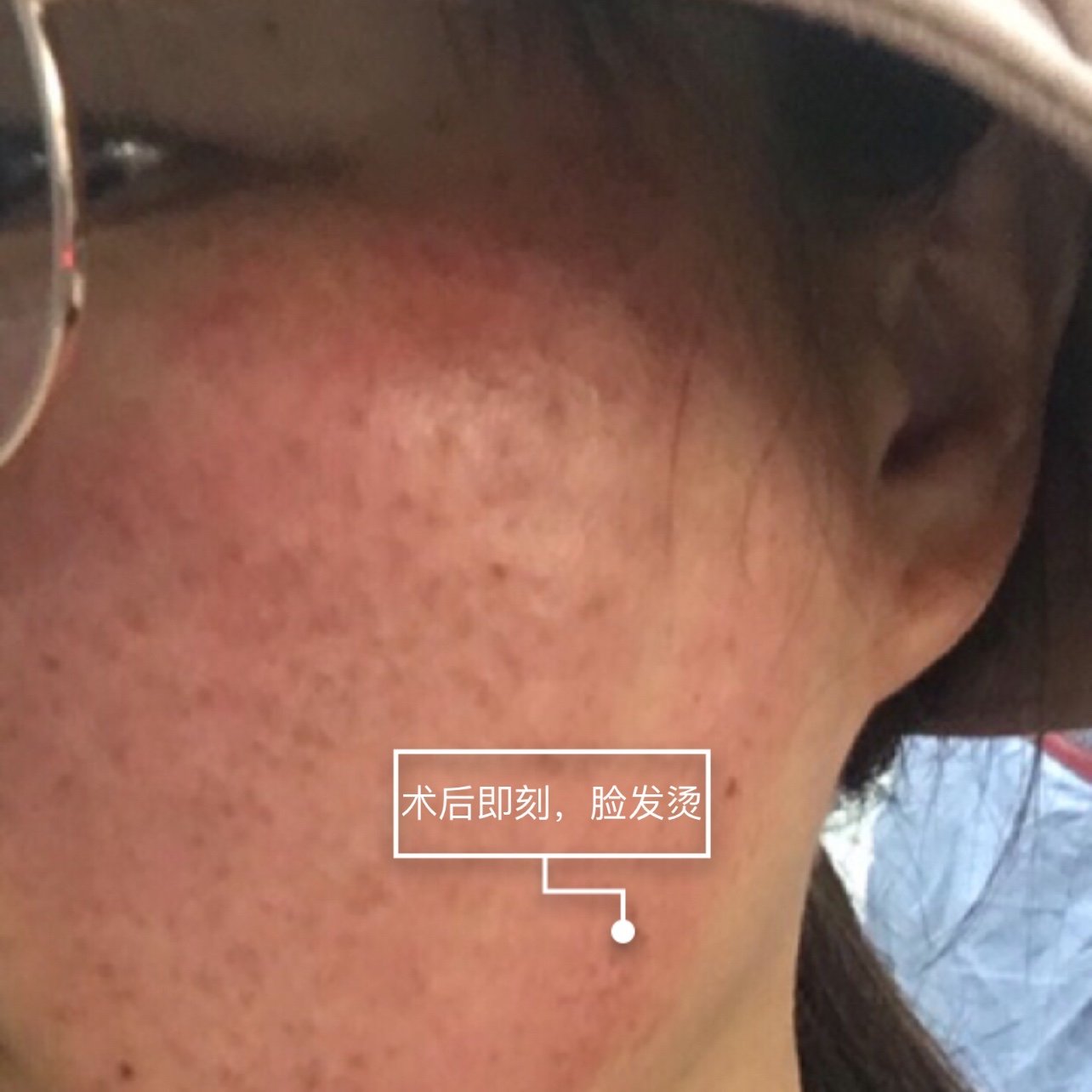 刚做完光子嫩肤的时候,脸就开始发烫,医生小姐姐们很_圈子-新氧美容