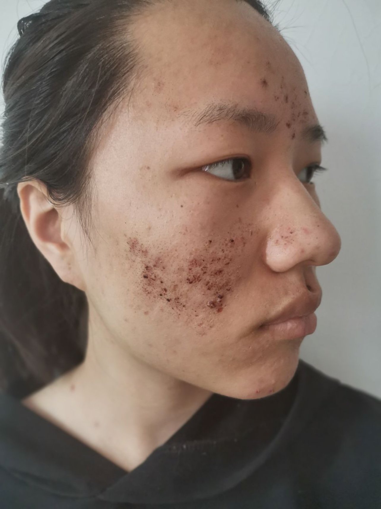 结的痂好像在变小,颜色也在变深,可能是要脱落的征兆_圈子-新氧美容