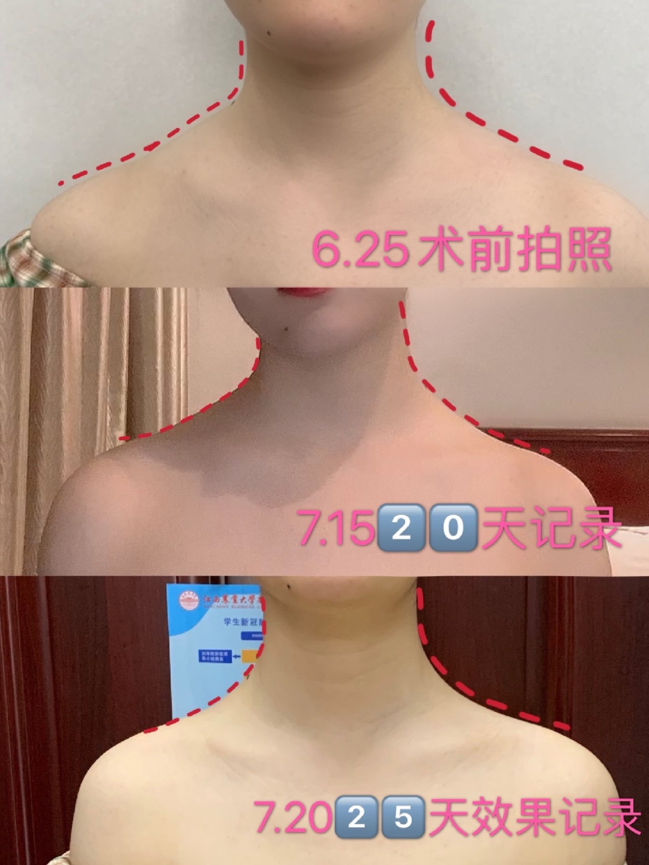 肉毒瘦肩针效果分享 姐妹们 圈子 新氧美容整形