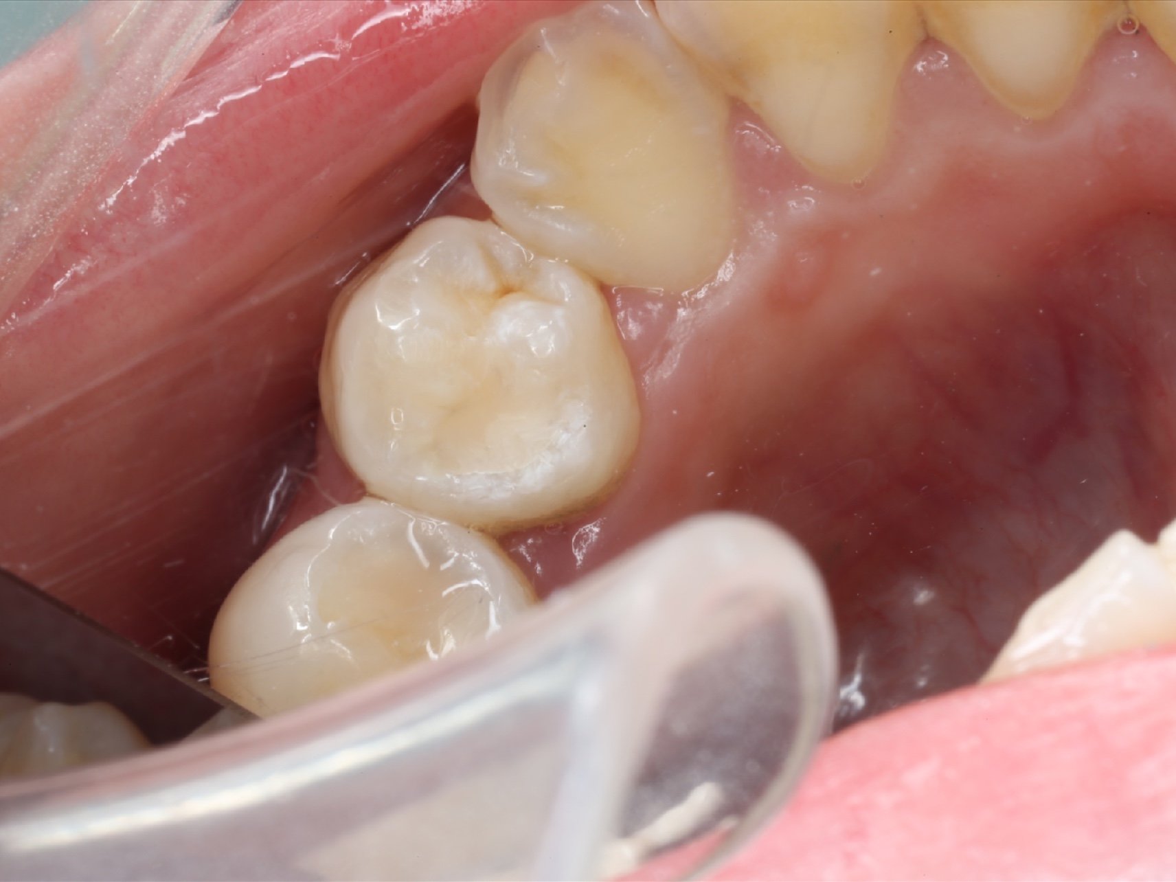 地方用银汞合金补的牙齿材料要掉了,这次来到杨浦区的一家牙博士补牙