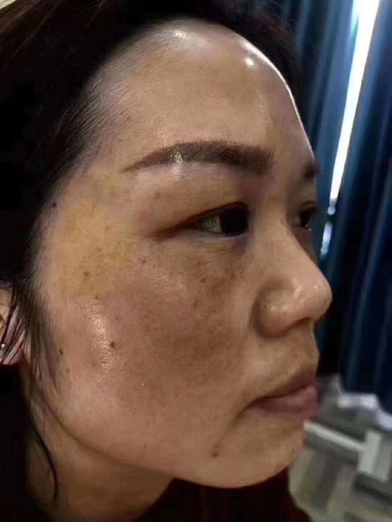 69溶斑术61含不69激61不素69含61汞铅_圈子-新氧美容整形