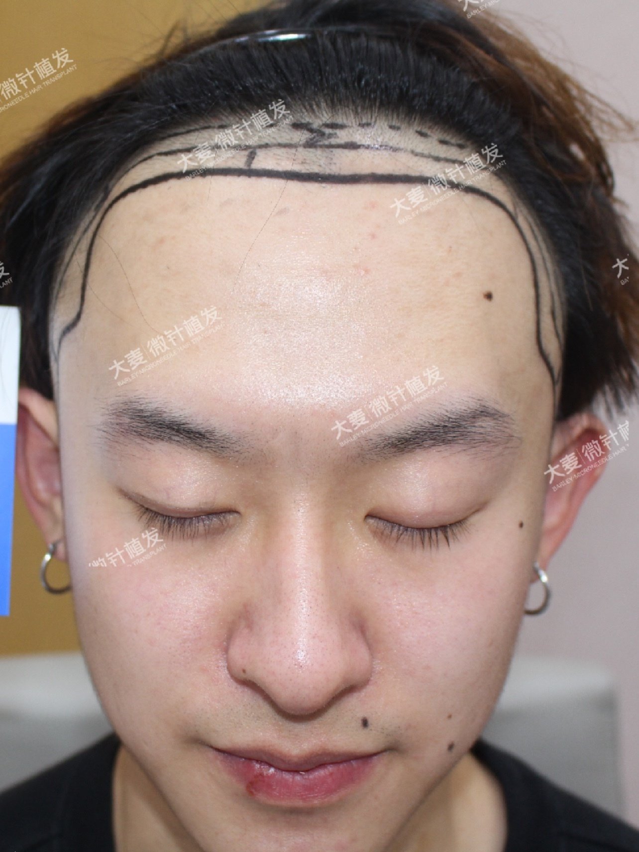 现在谁也不能说我的发际线高了,我还做了个好看的鬓角呢