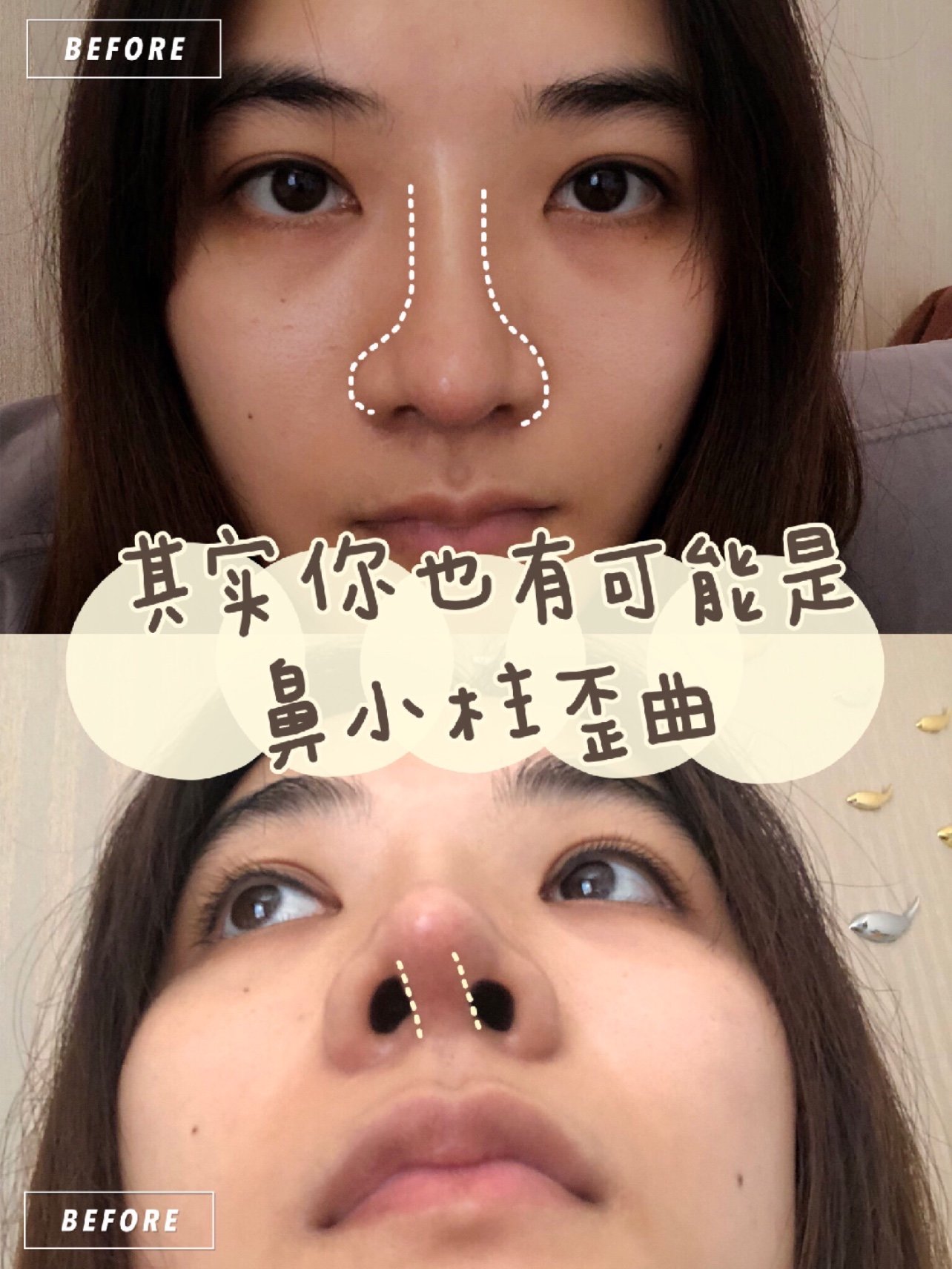 其实你也有可能是鼻小柱歪曲