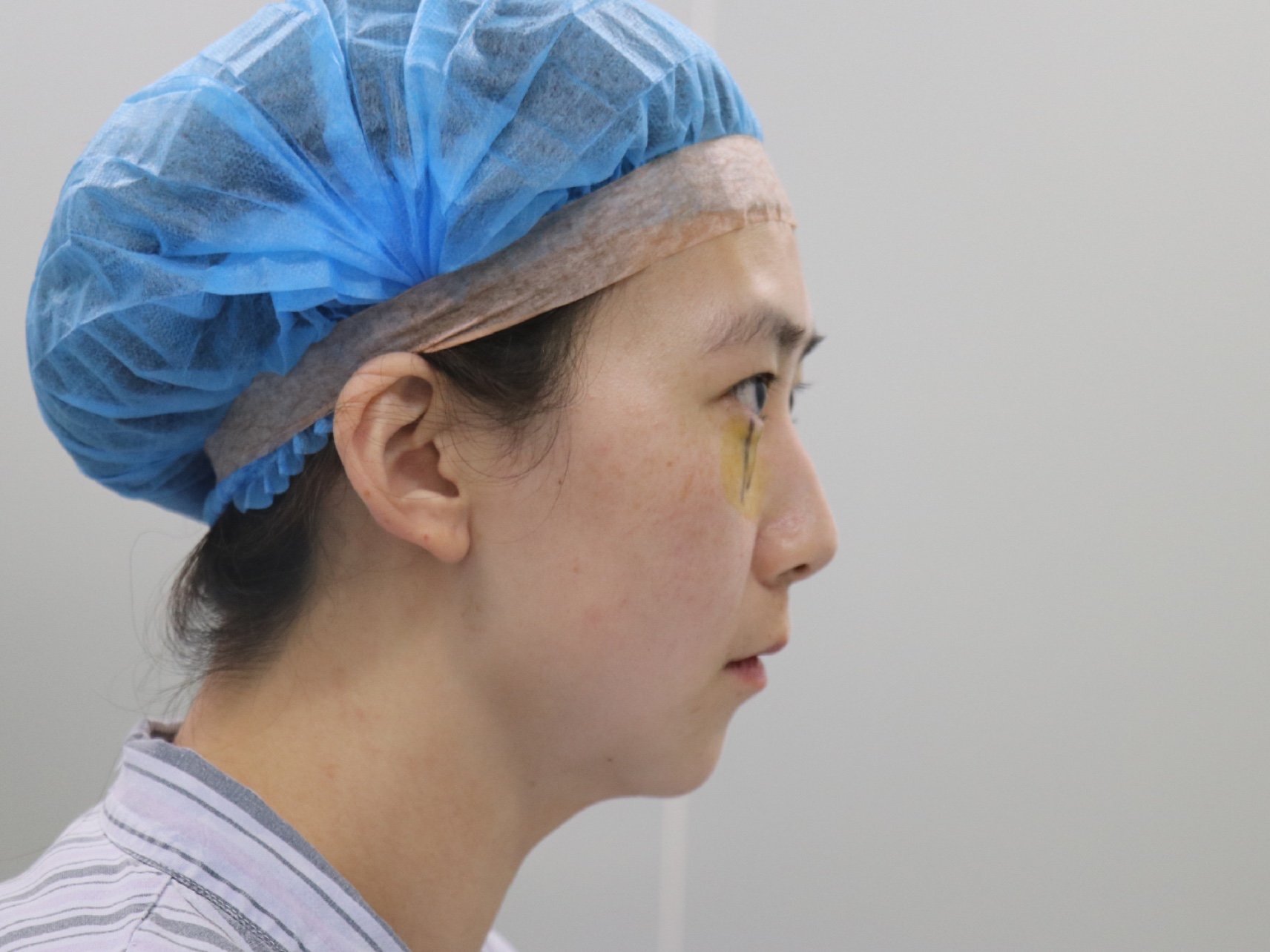 下眼下至探店术前