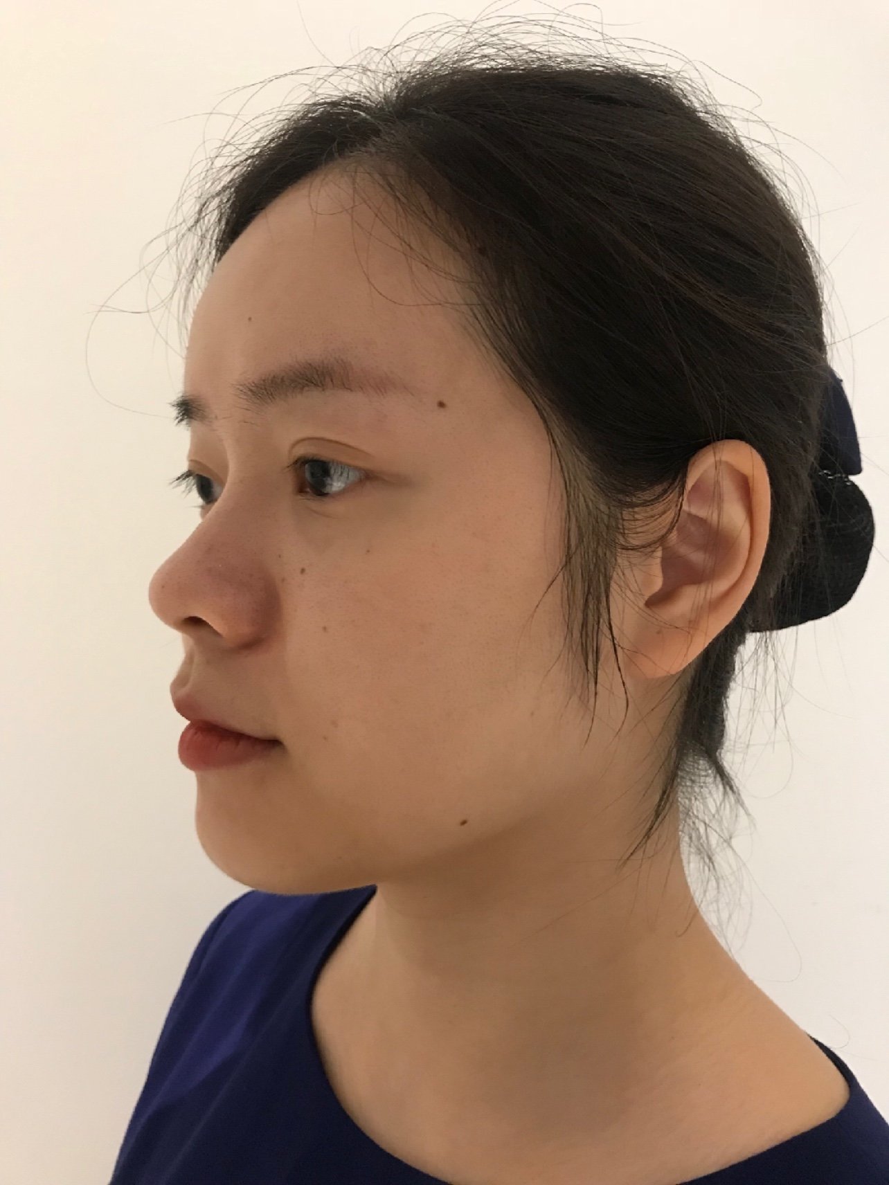 凹陷脸女孩的真实分享78